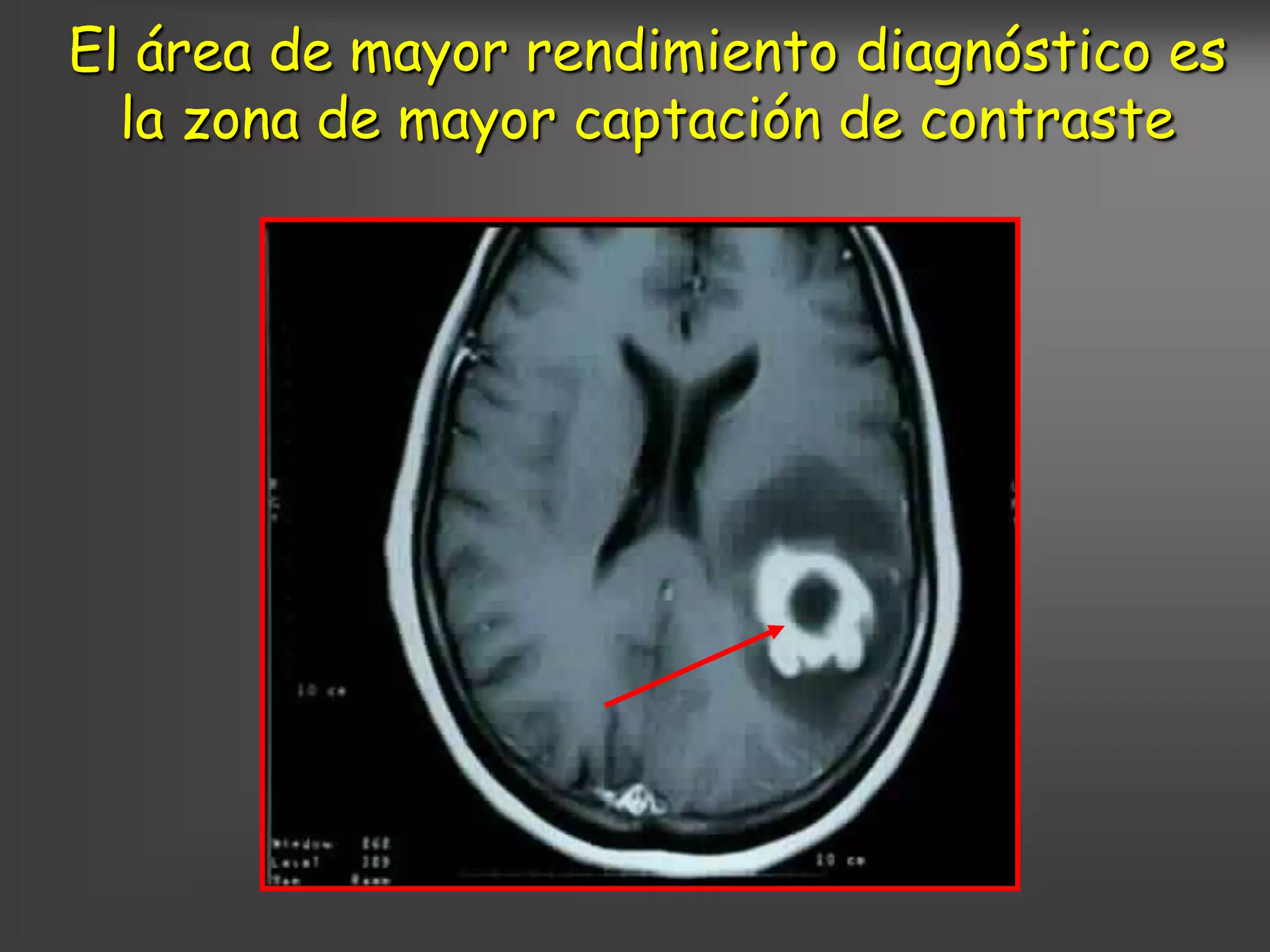 El área de mayor rendimiento diagnóstico es
  la zona de mayor captación de contraste
 