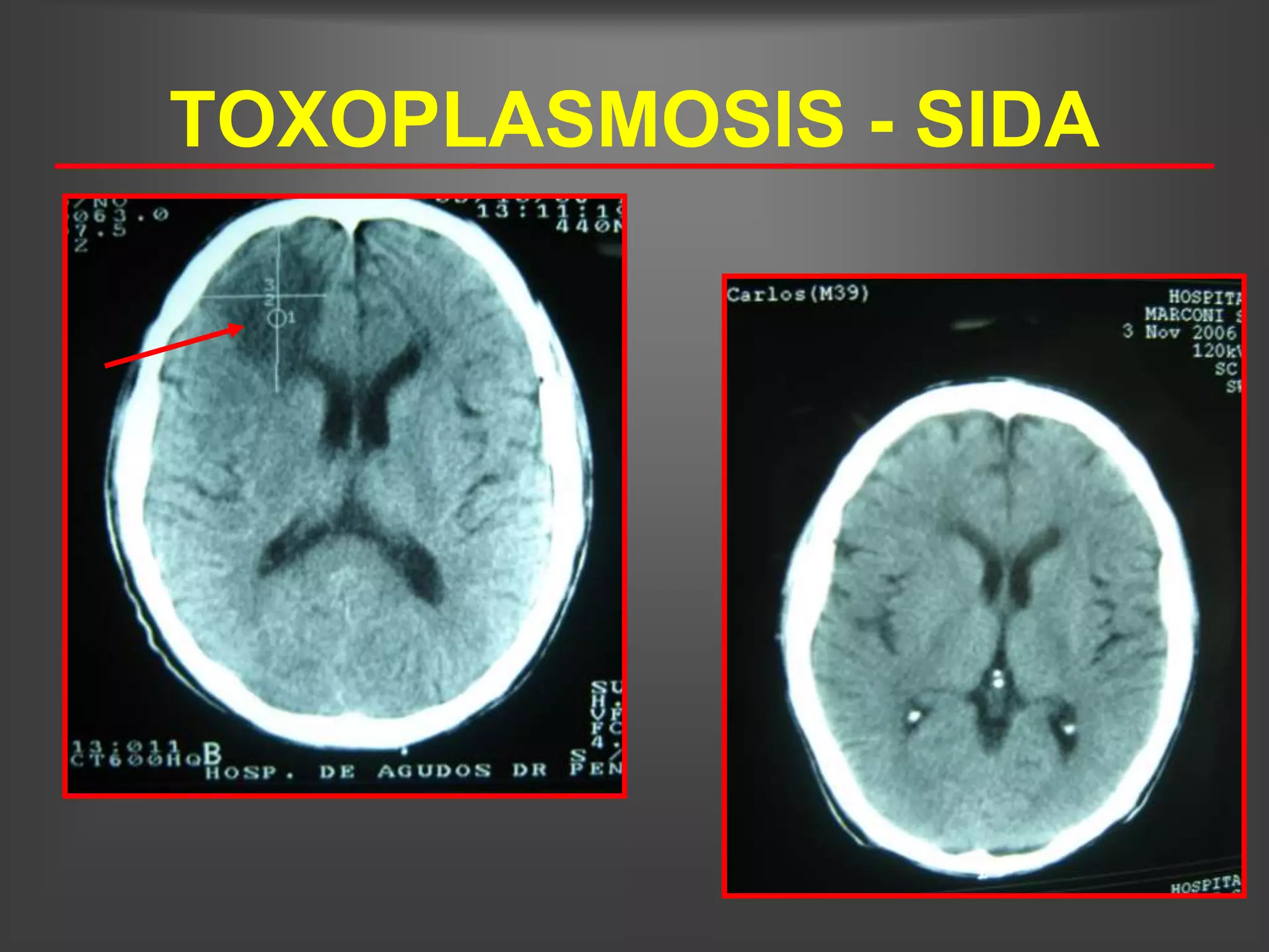TOXOPLASMOSIS - SIDA
 