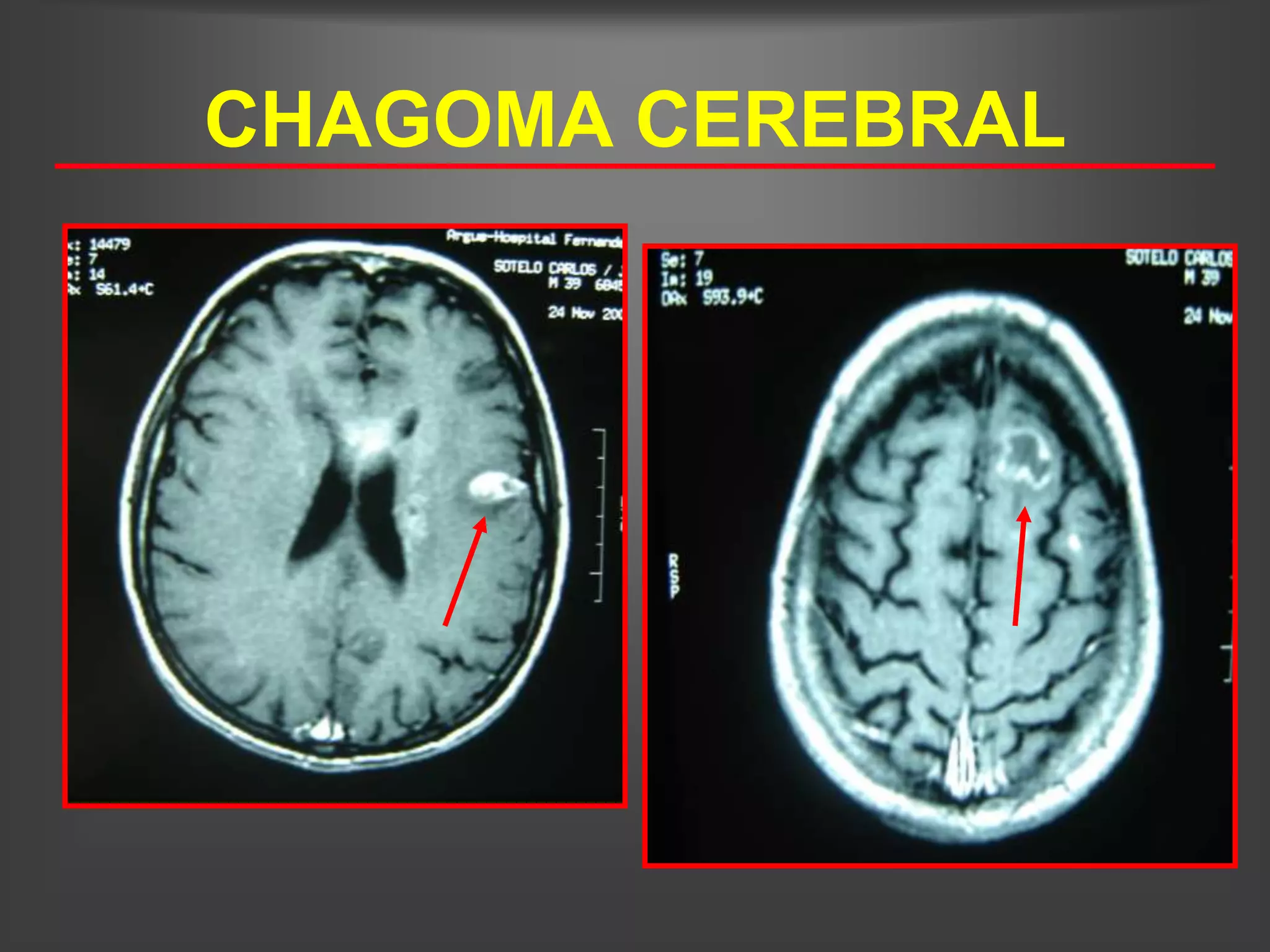 CHAGOMA CEREBRAL
 