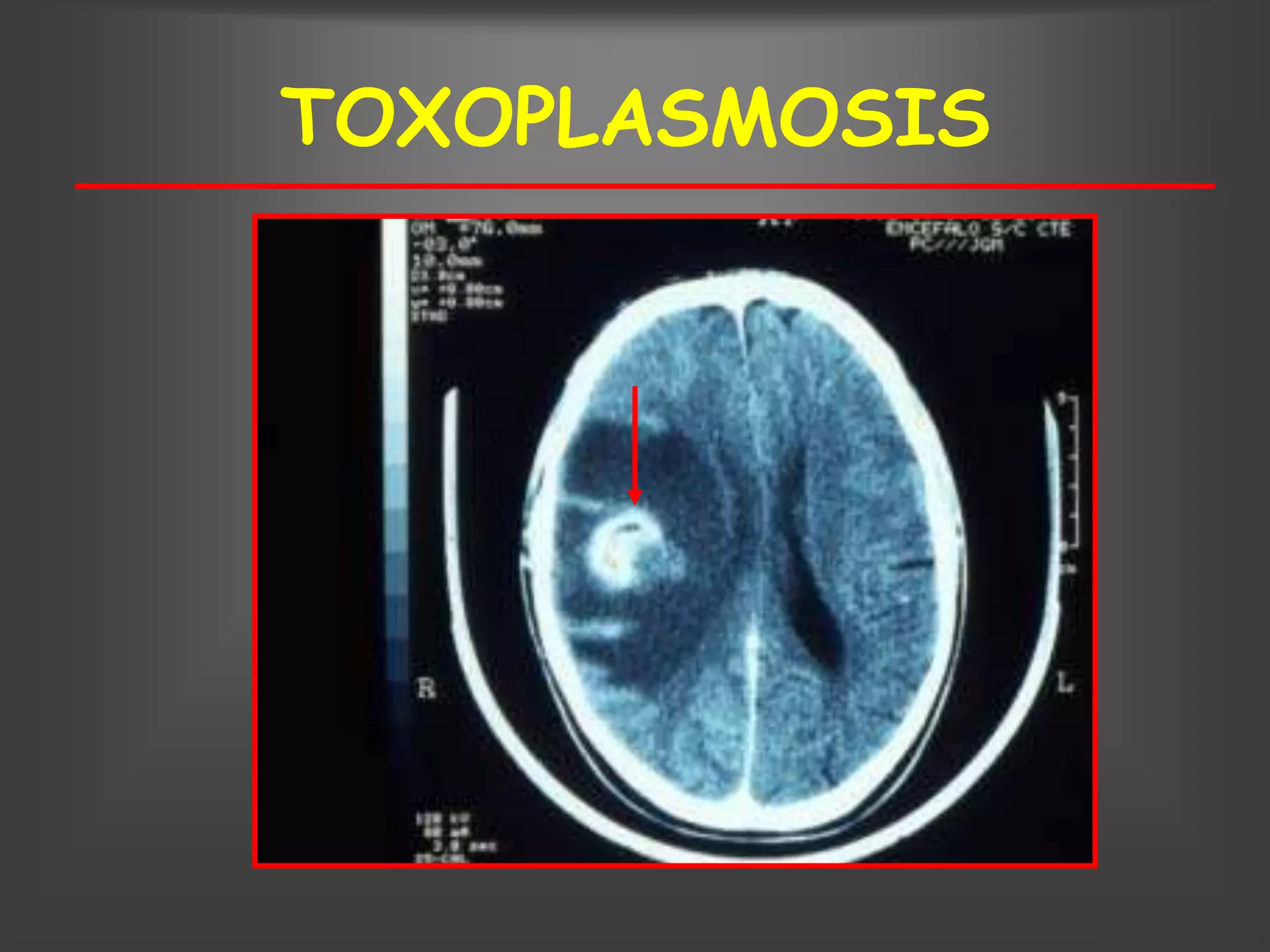 TOXOPLASMOSIS
 