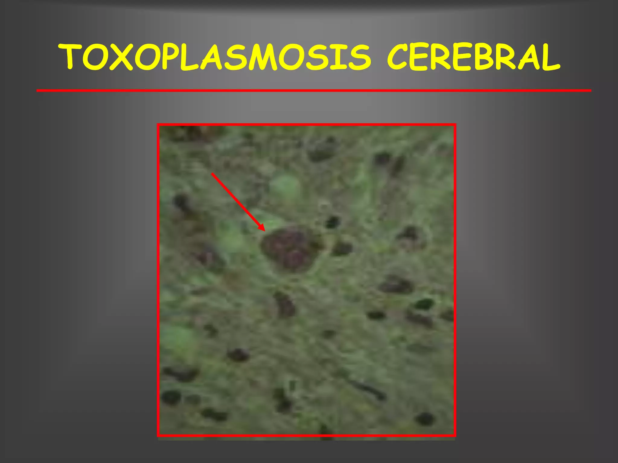 TOXOPLASMOSIS CEREBRAL
 