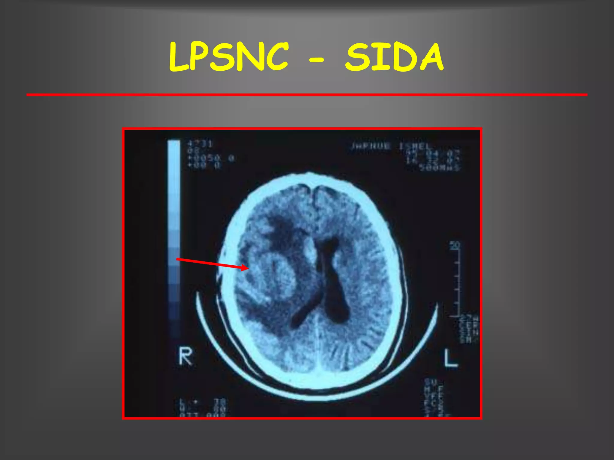 LPSNC - SIDA
 