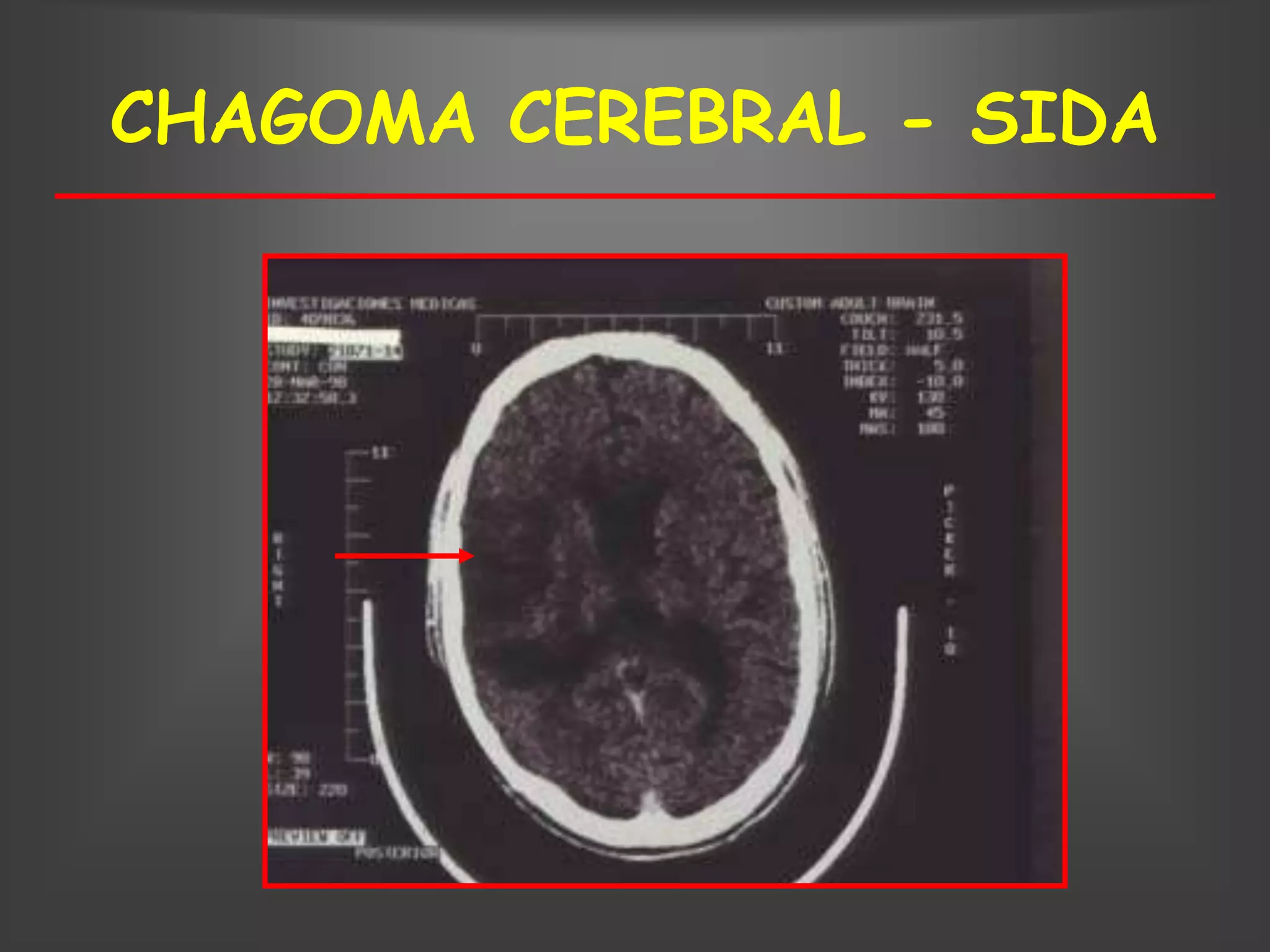 CHAGOMA CEREBRAL - SIDA
 