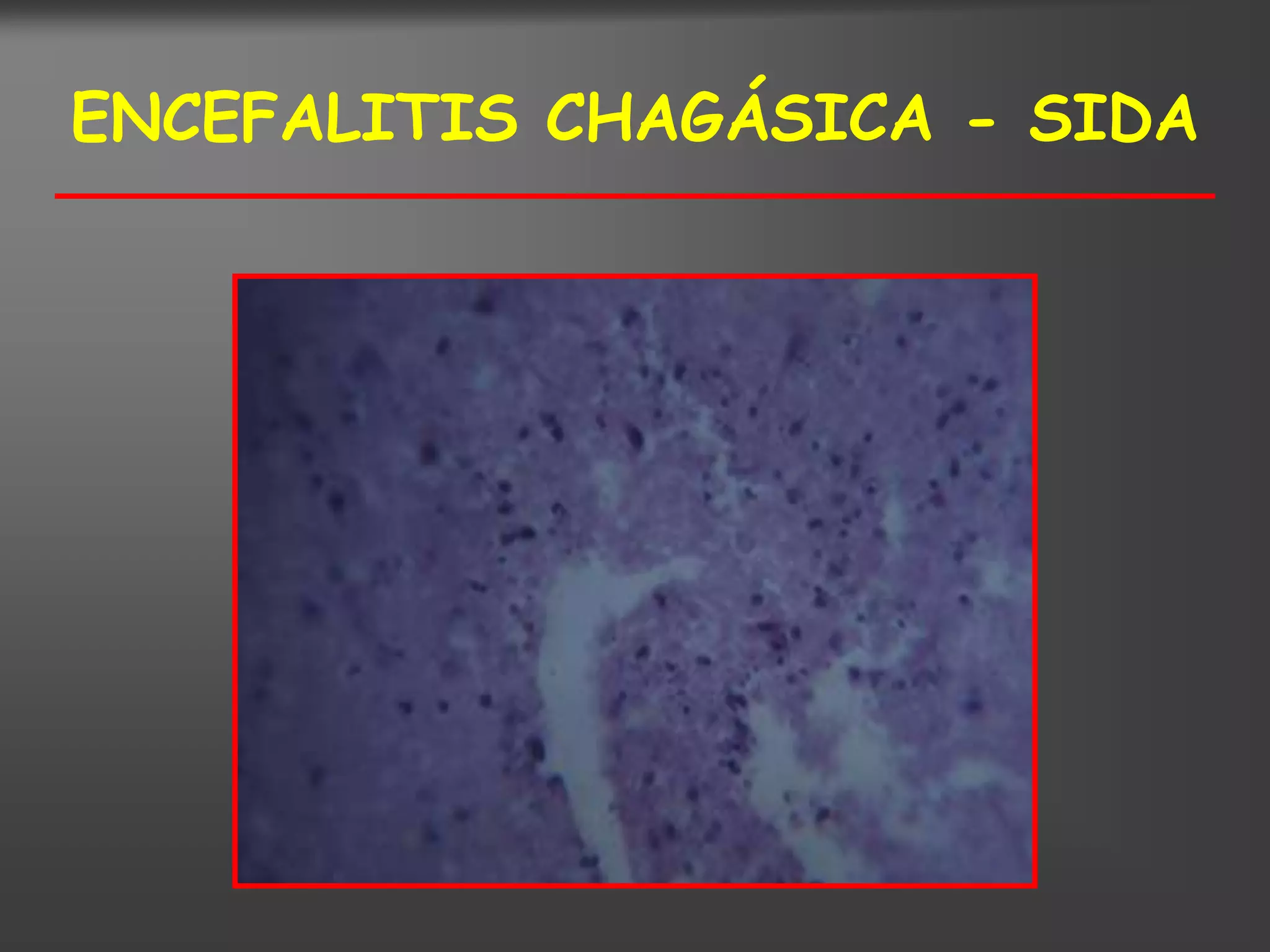 ENCEFALITIS CHAGÁSICA - SIDA
 