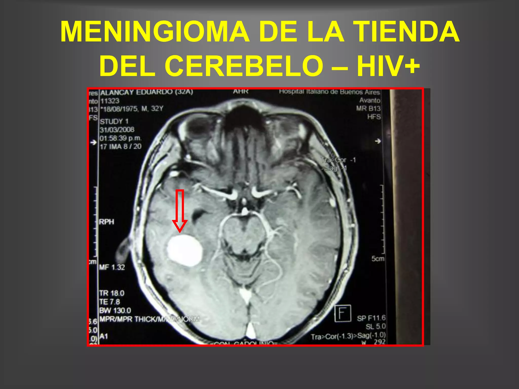 MENINGIOMA DE LA TIENDA
  DEL CEREBELO – HIV+
 