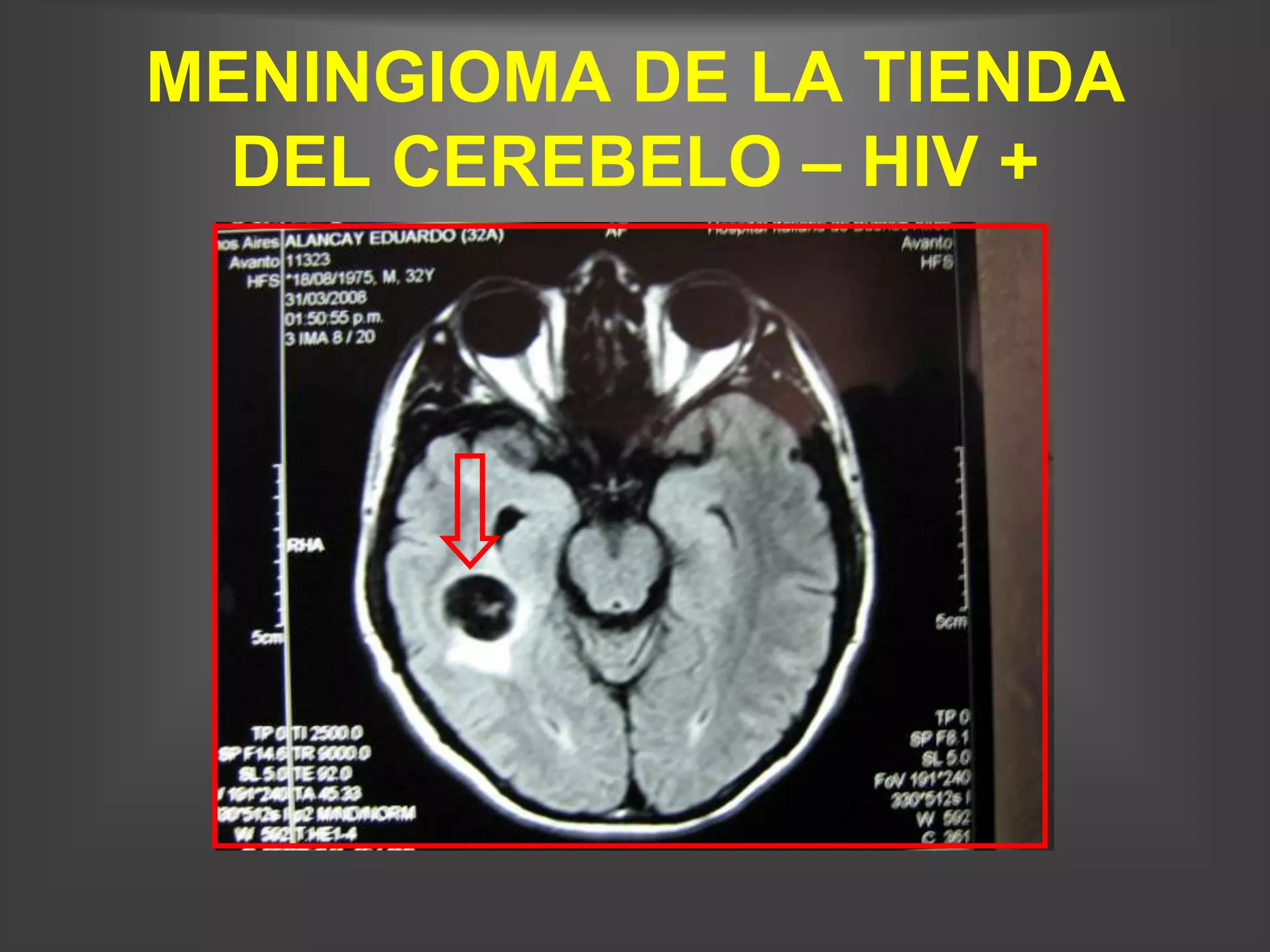 MENINGIOMA DE LA TIENDA
  DEL CEREBELO – HIV +
 