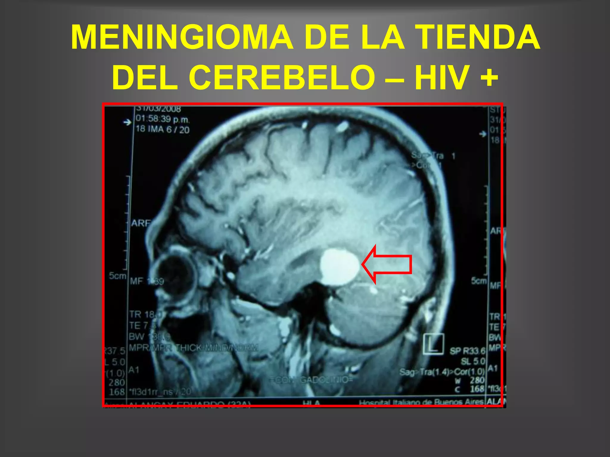 MENINGIOMA DE LA TIENDA
  DEL CEREBELO – HIV +
 