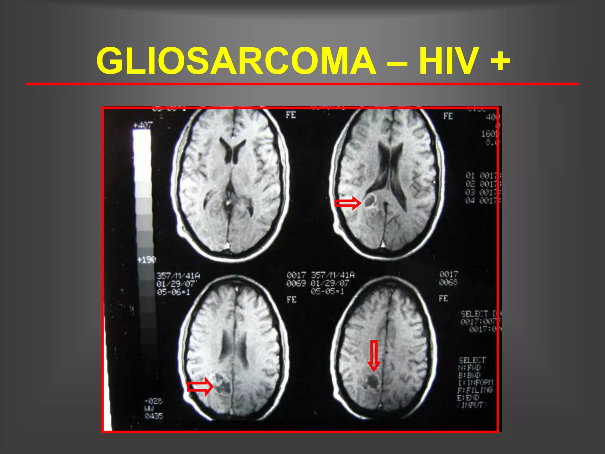 GLIOSARCOMA – HIV +
 