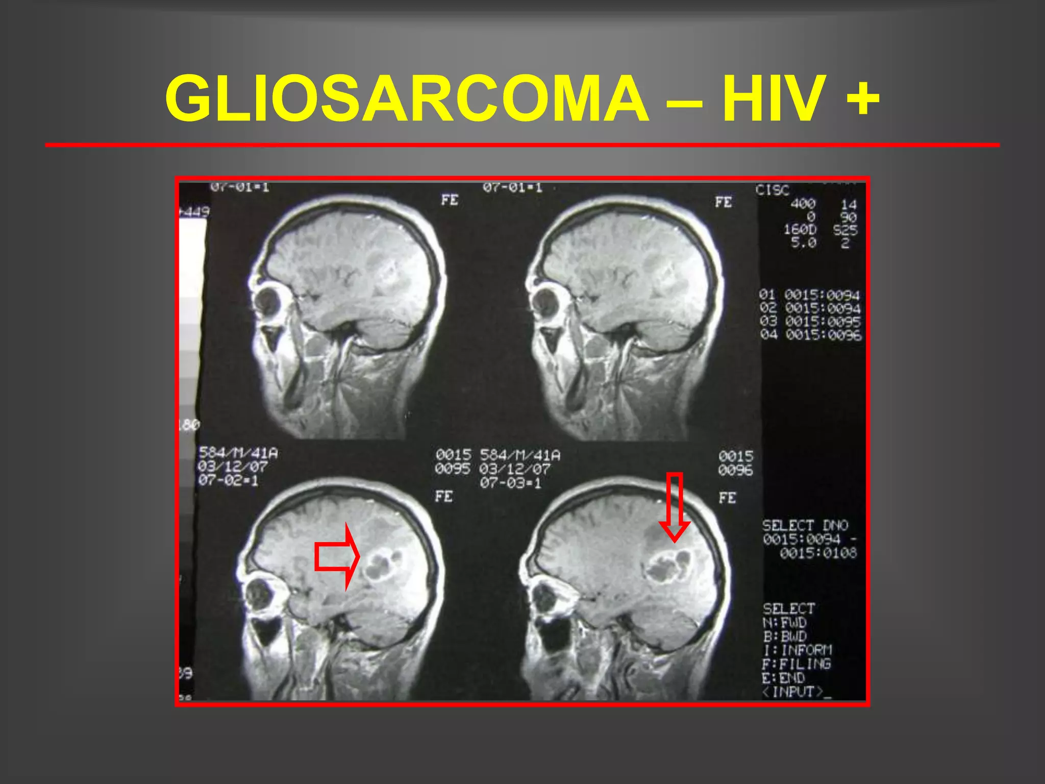 GLIOSARCOMA – HIV +
 