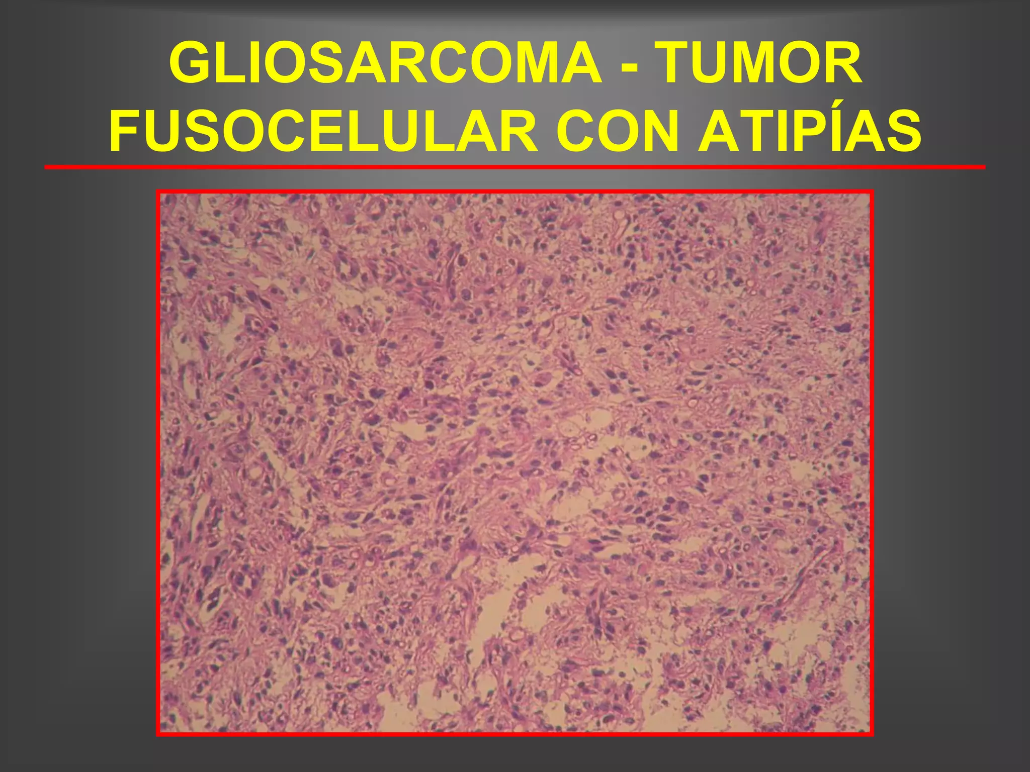 GLIOSARCOMA - TUMOR
FUSOCELULAR CON ATIPÍAS
 