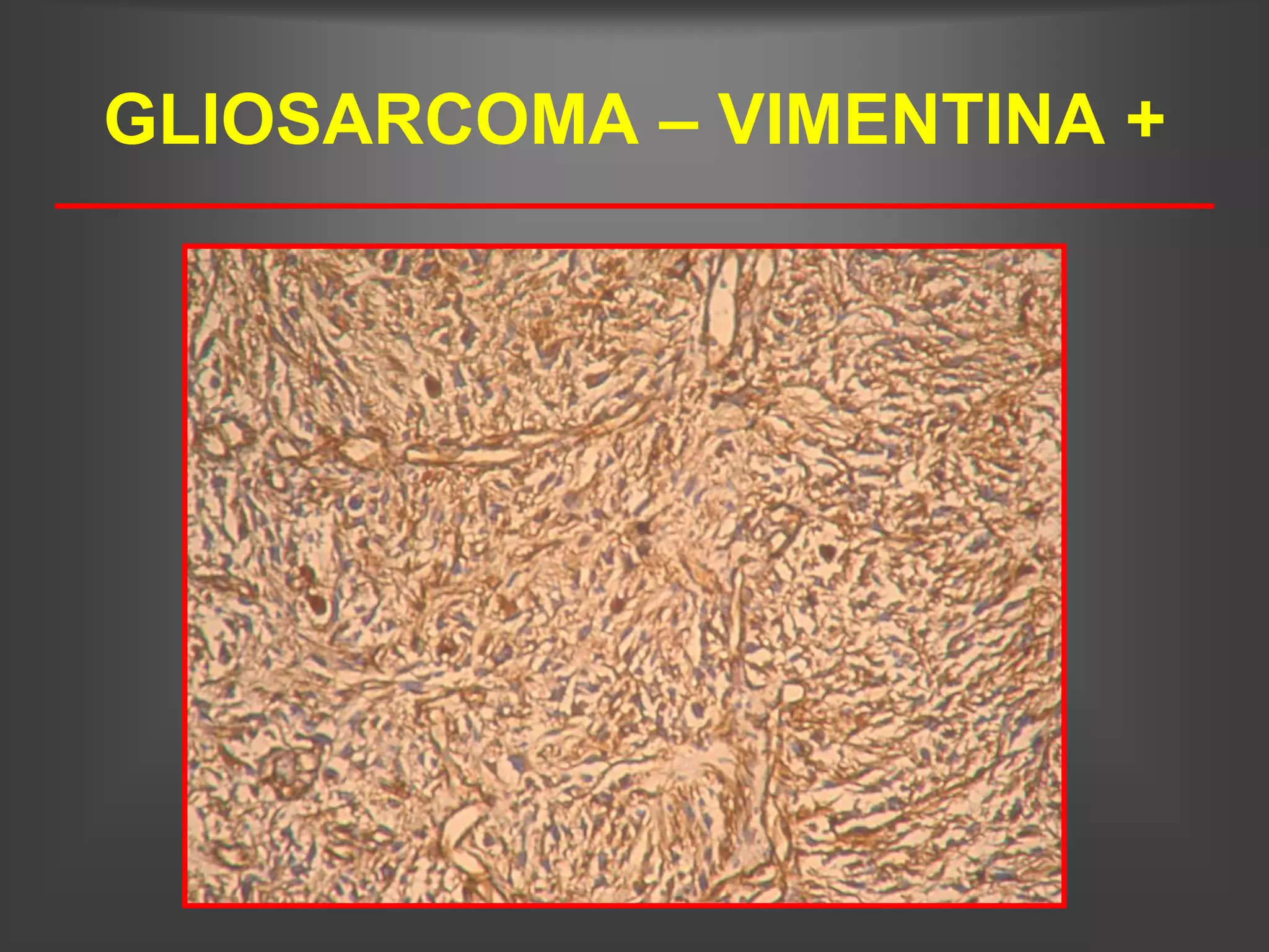 GLIOSARCOMA – VIMENTINA +
 