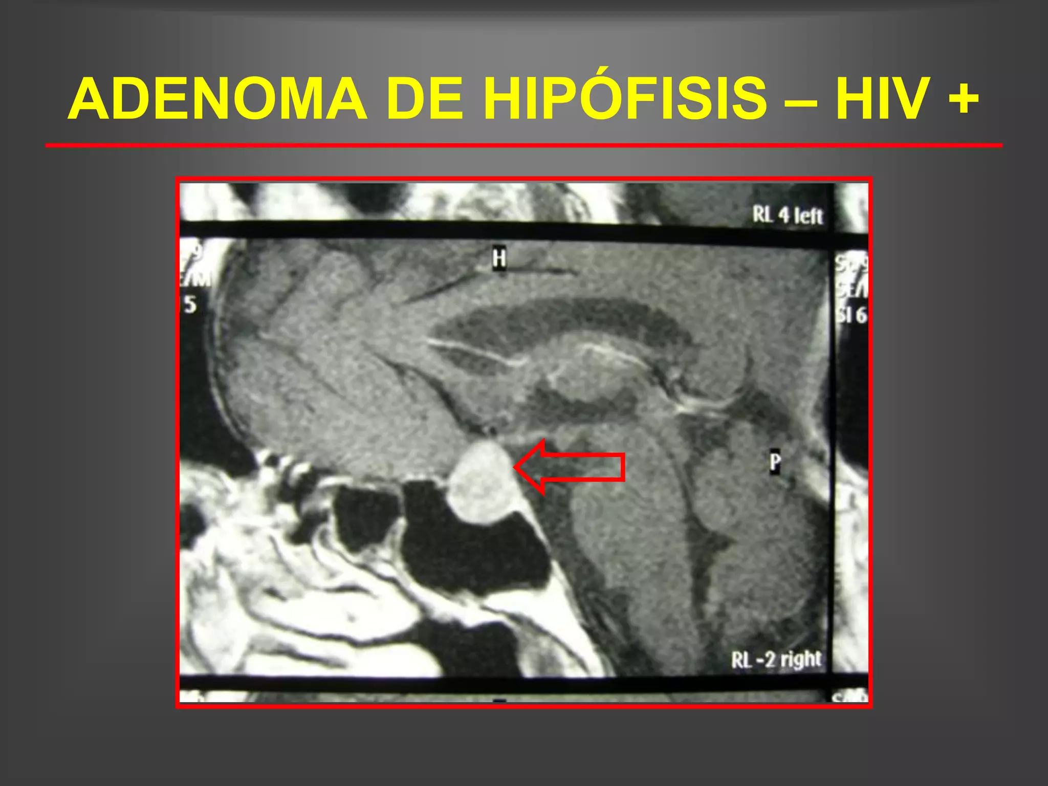 ADENOMA DE HIPÓFISIS – HIV +
 
