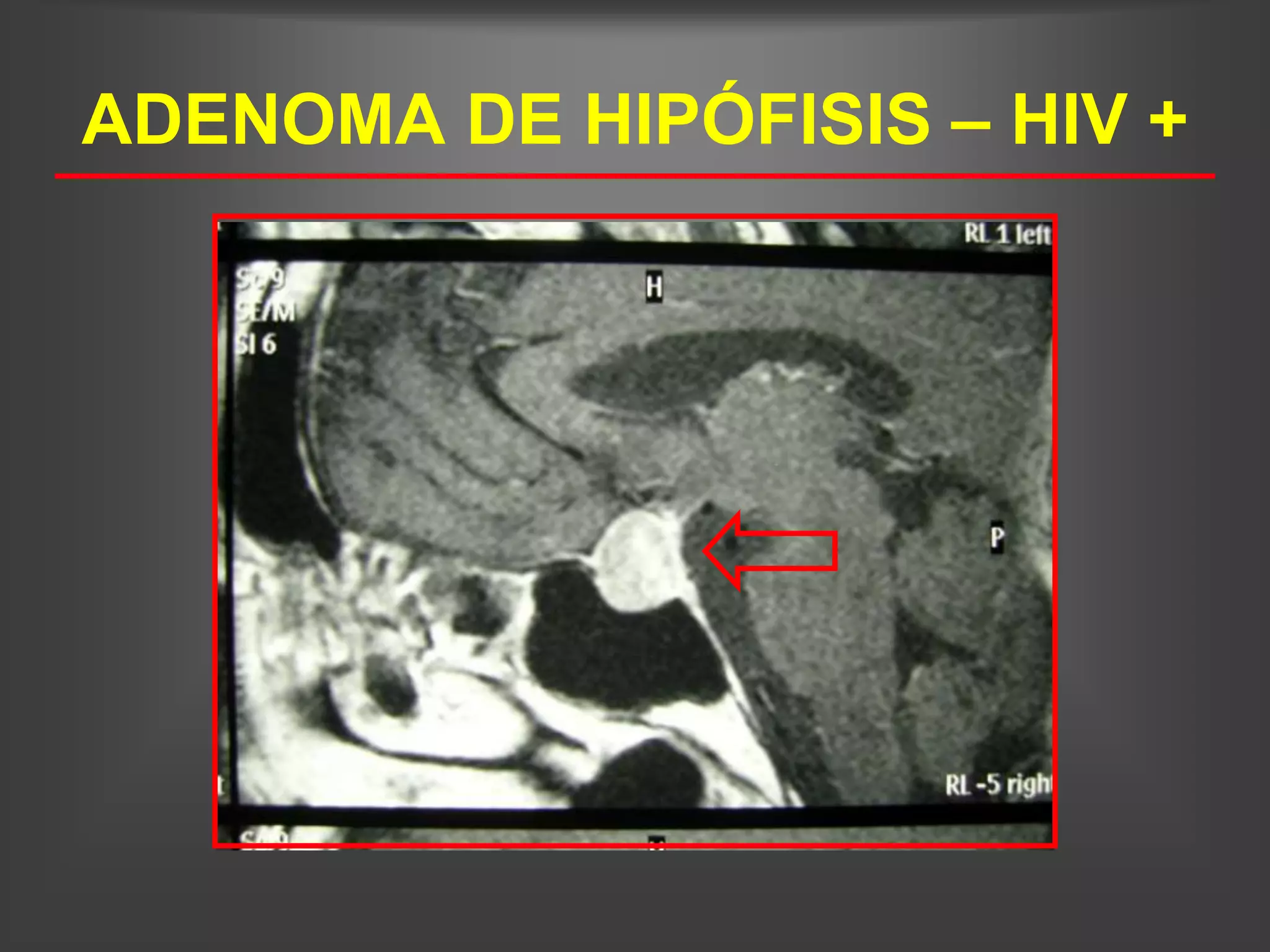 ADENOMA DE HIPÓFISIS – HIV +
 