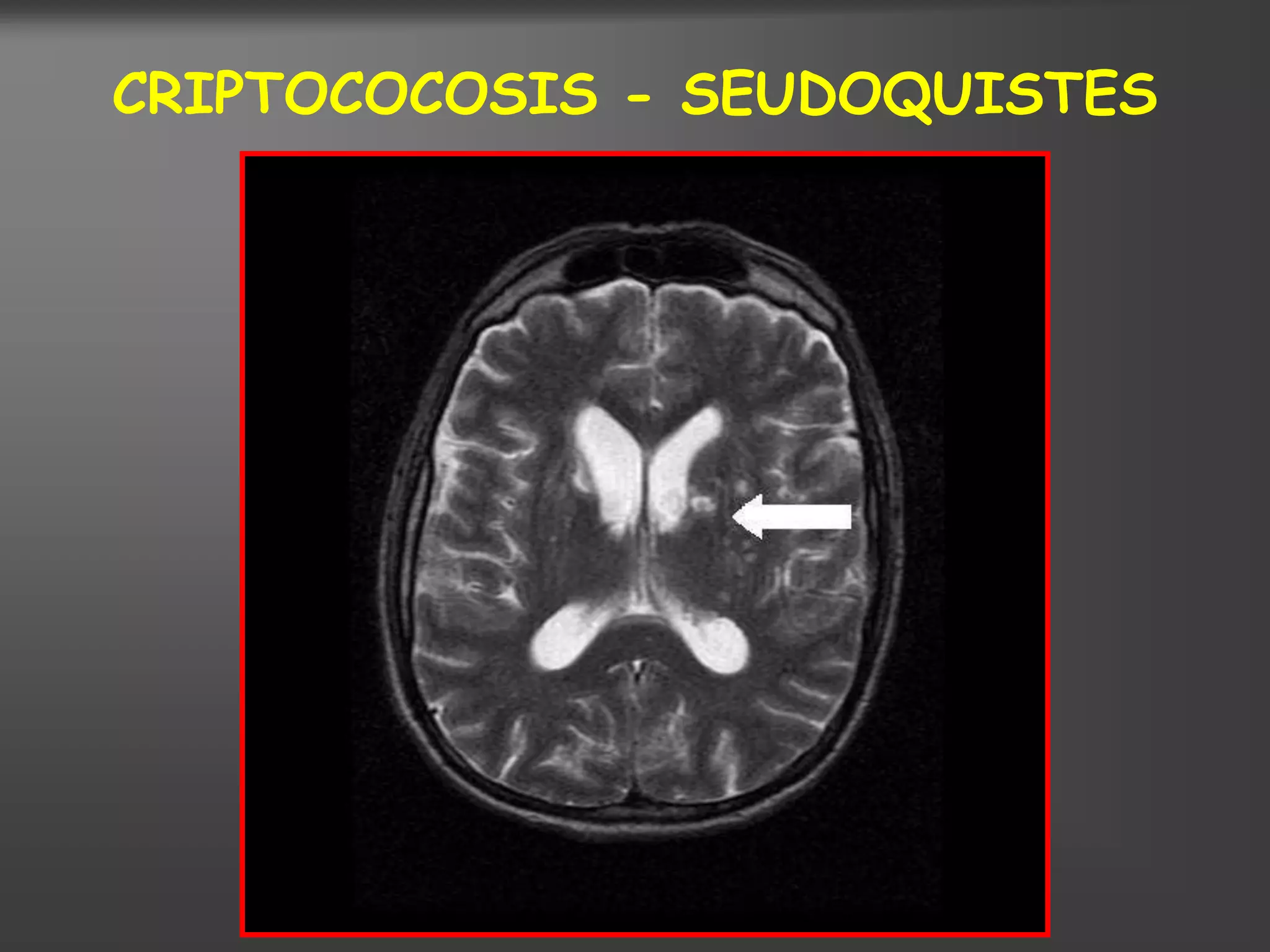 CRIPTOCOCOSIS - SEUDOQUISTES
 