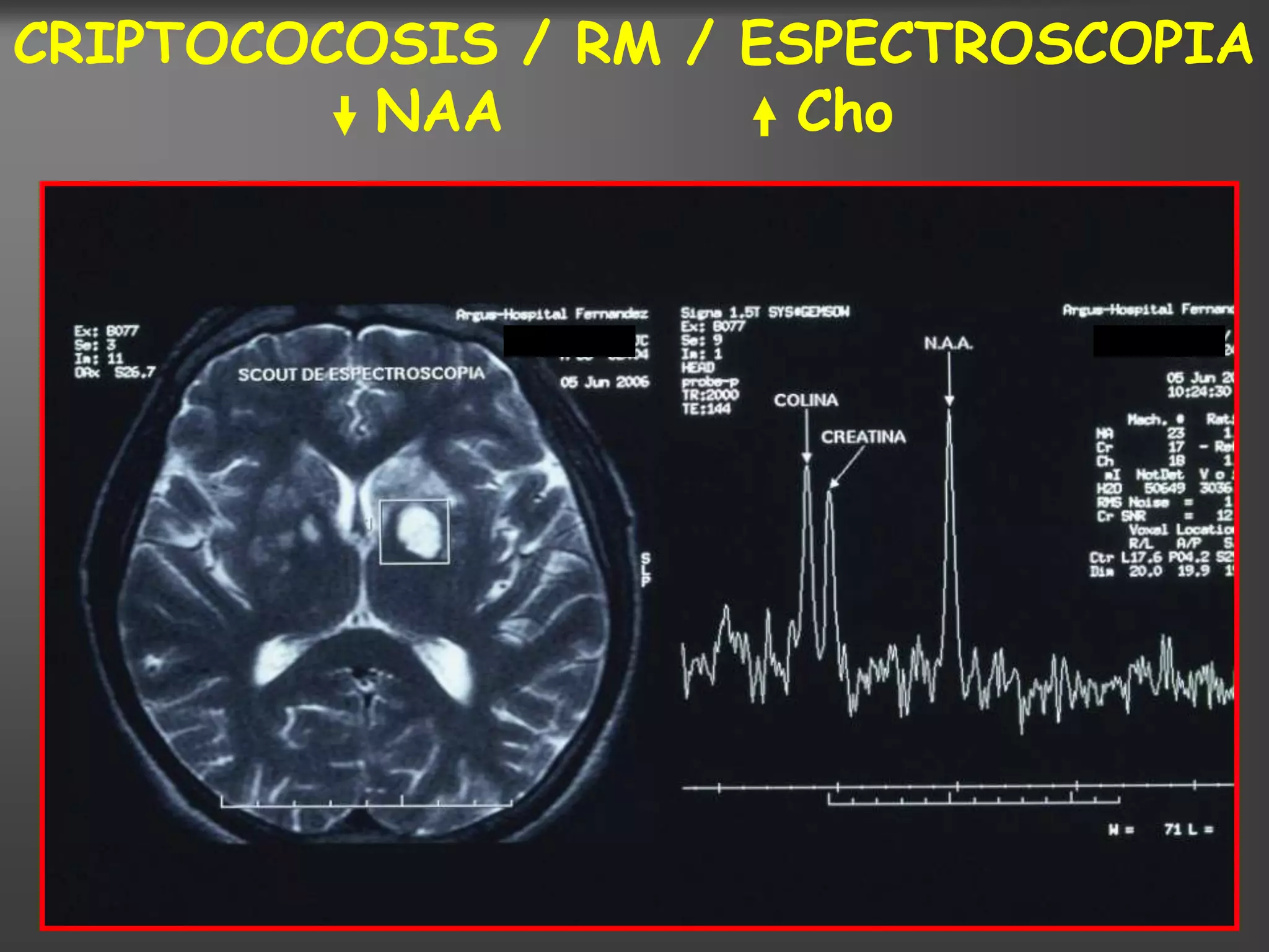 CRIPTOCOCOSIS / RM / ESPECTROSCOPIA
          NAA          Cho
 