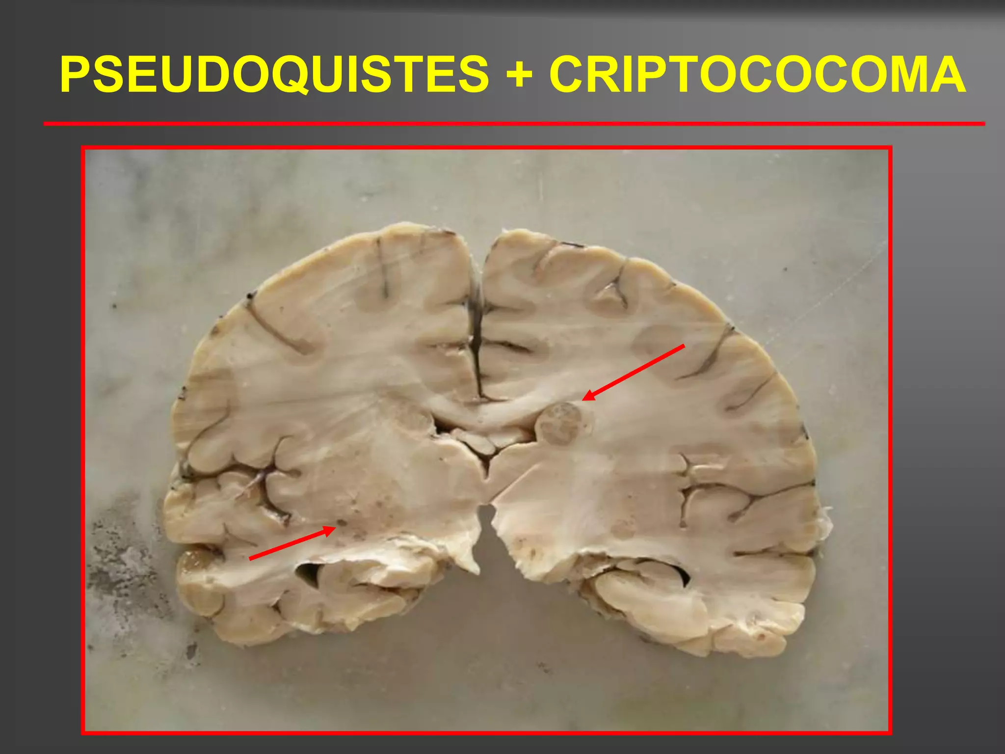 PSEUDOQUISTES + CRIPTOCOCOMA
 