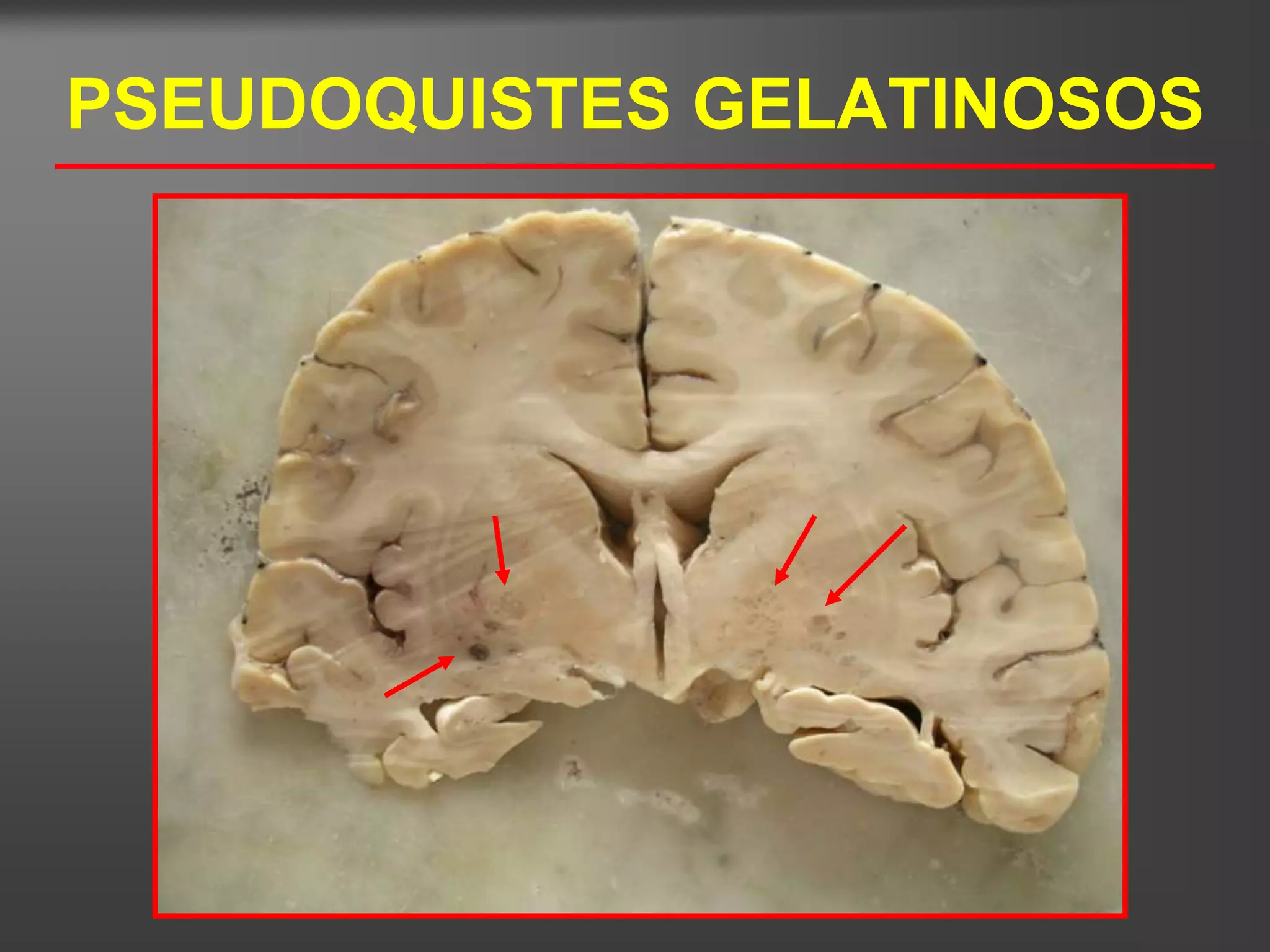 PSEUDOQUISTES GELATINOSOS
 