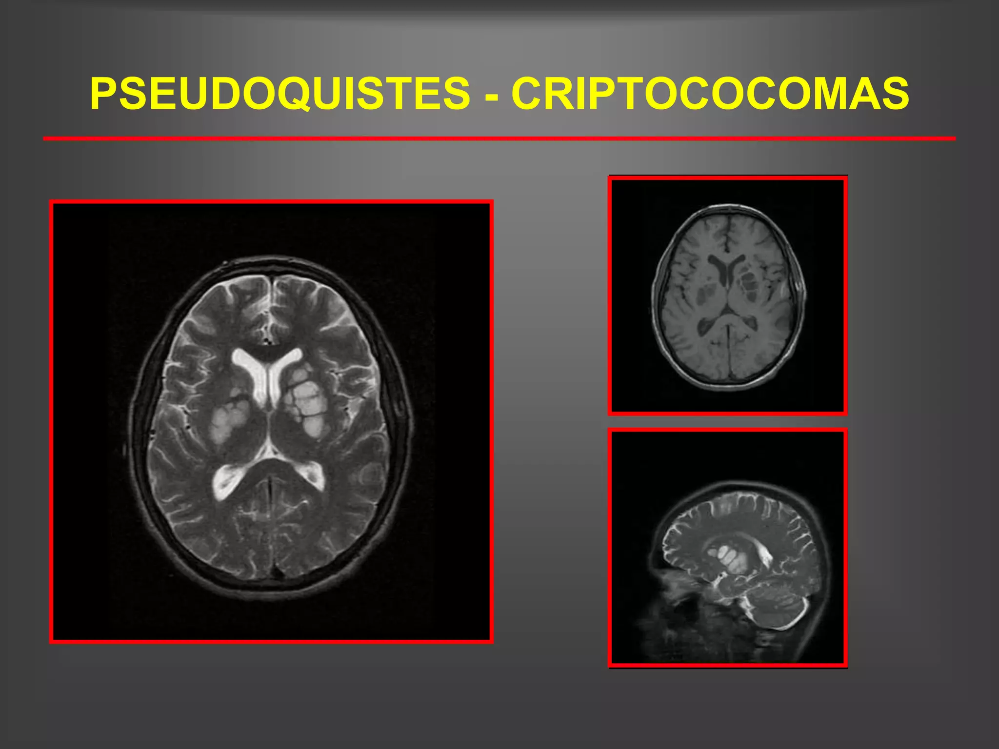PSEUDOQUISTES - CRIPTOCOCOMAS
 