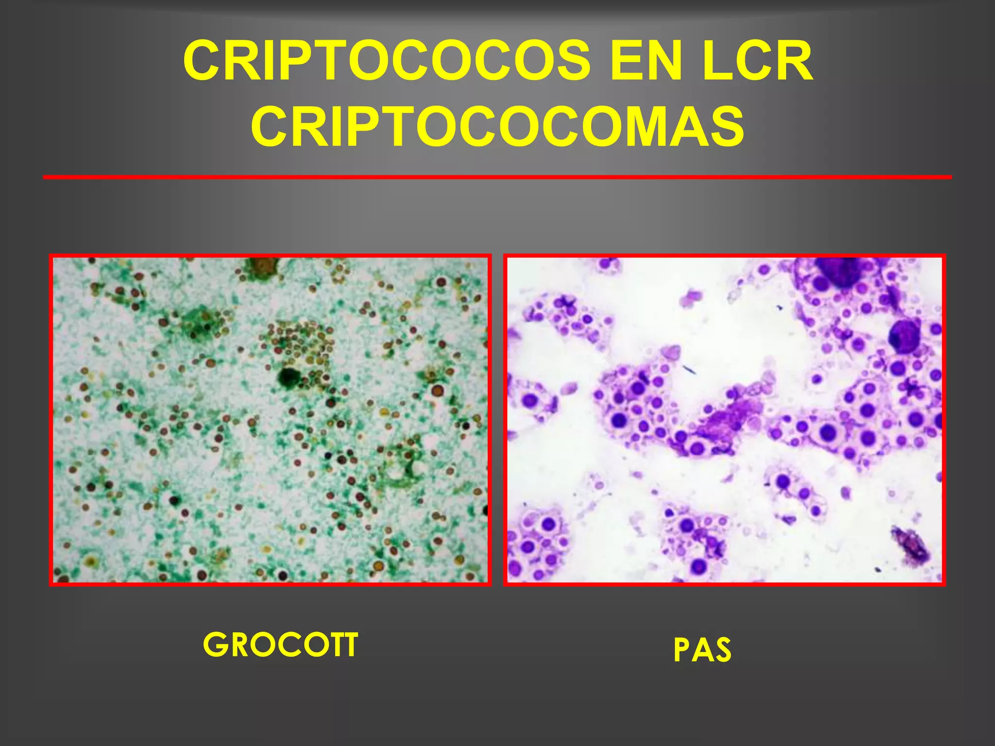 CRIPTOCOCOS EN LCR
  CRIPTOCOCOMAS




GROCOTT      PAS
 