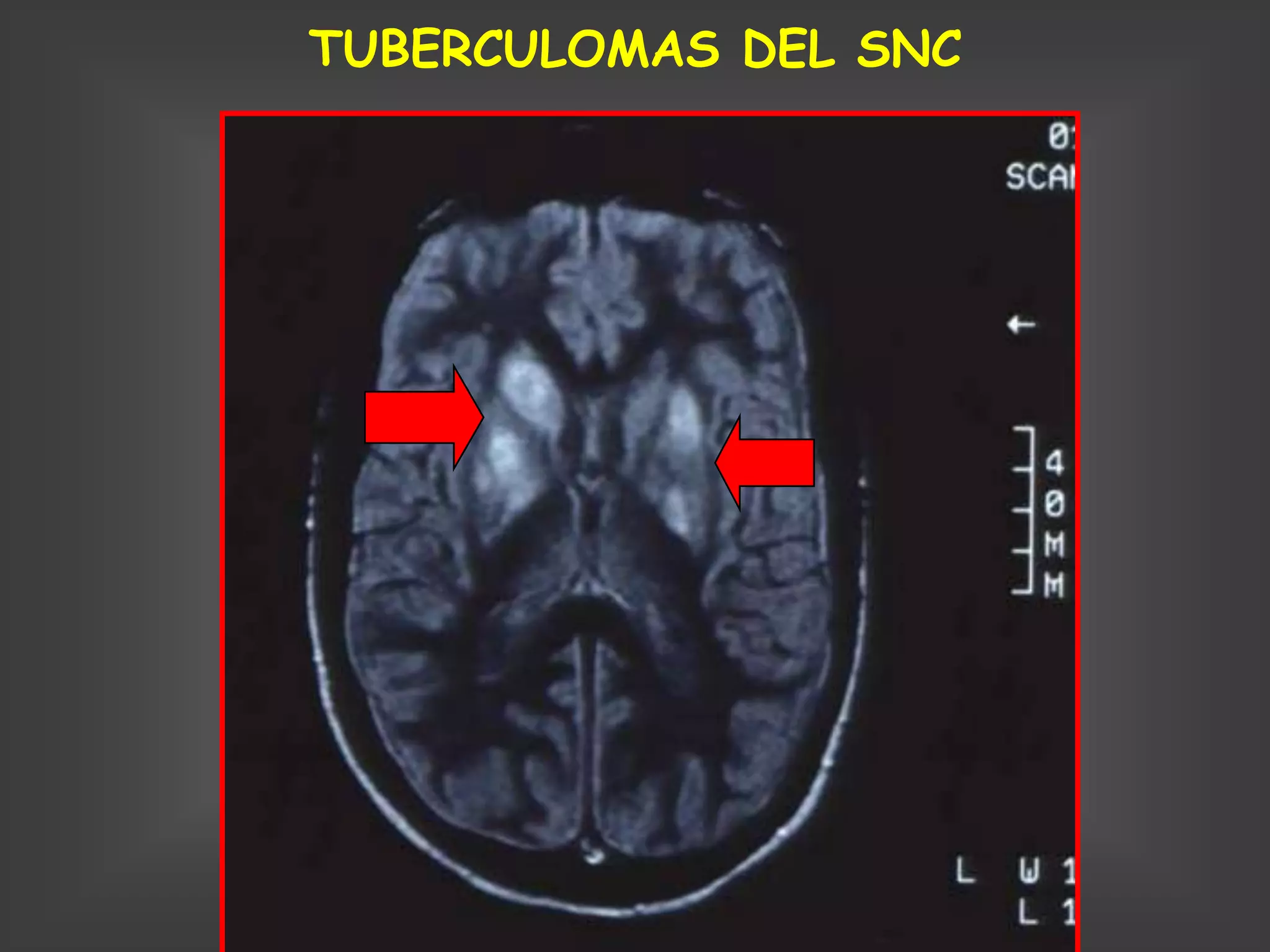 TUBERCULOMAS DEL SNC
 