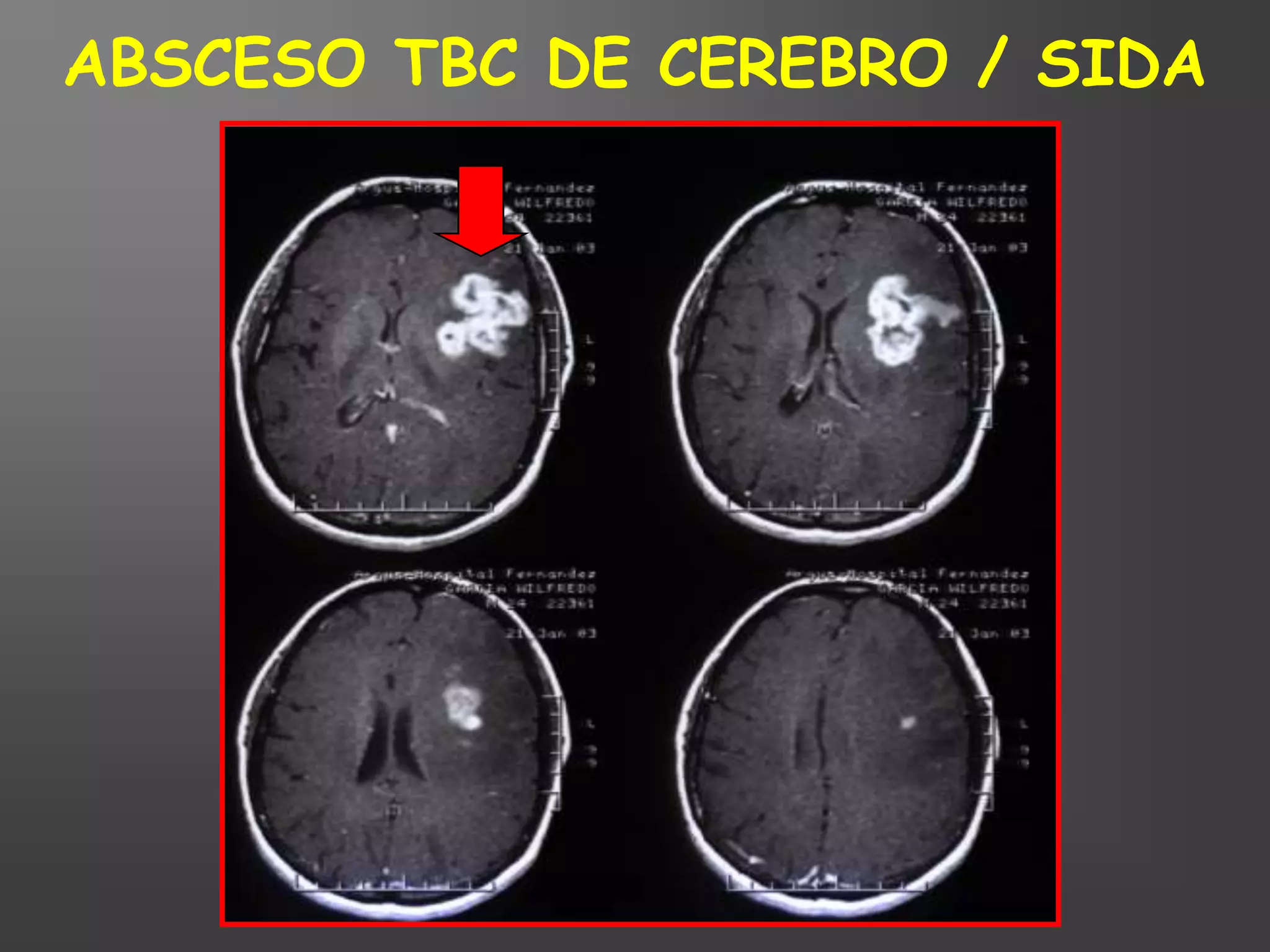 ABSCESO TBC DE CEREBRO / SIDA
 