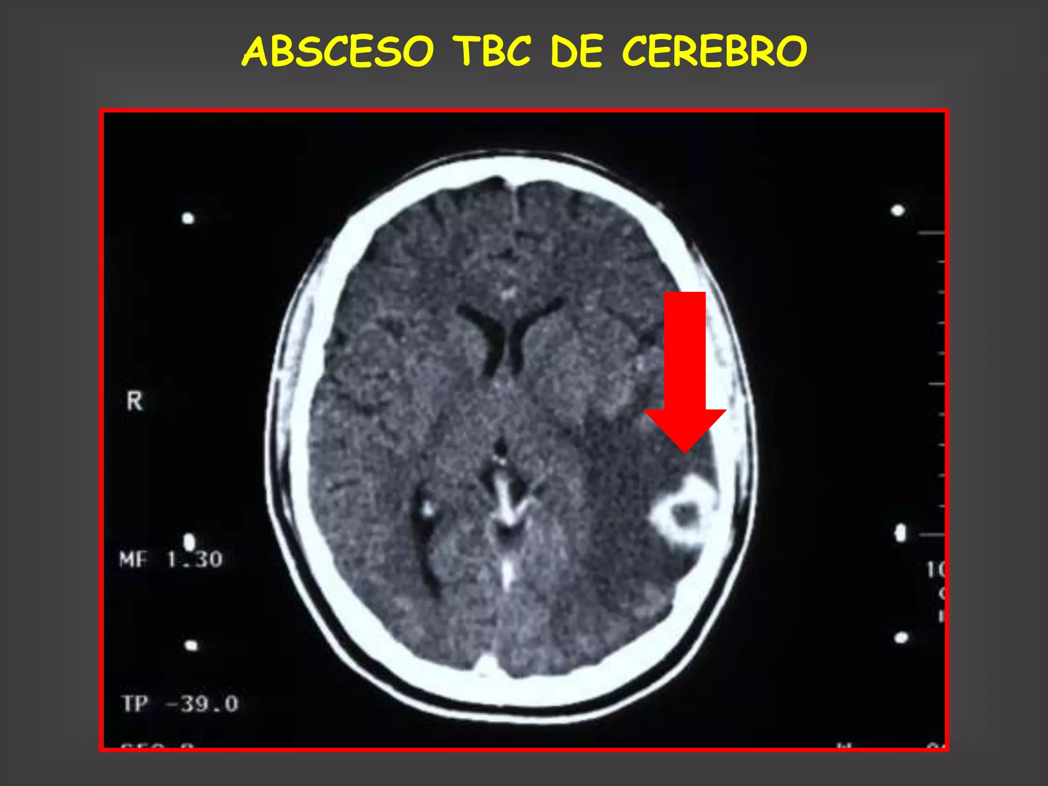 ABSCESO TBC DE CEREBRO
 