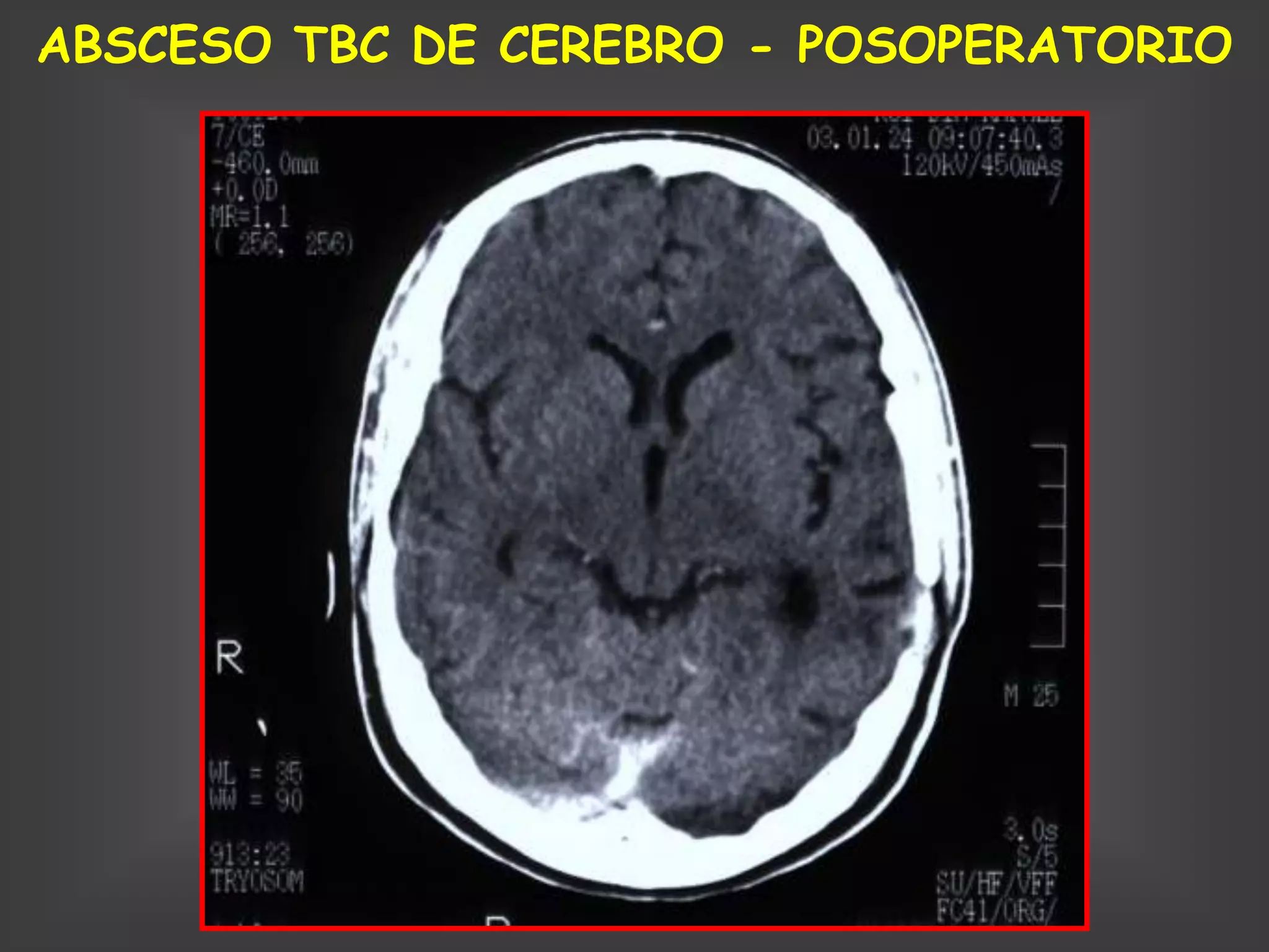ABSCESO TBC DE CEREBRO - POSOPERATORIO
 