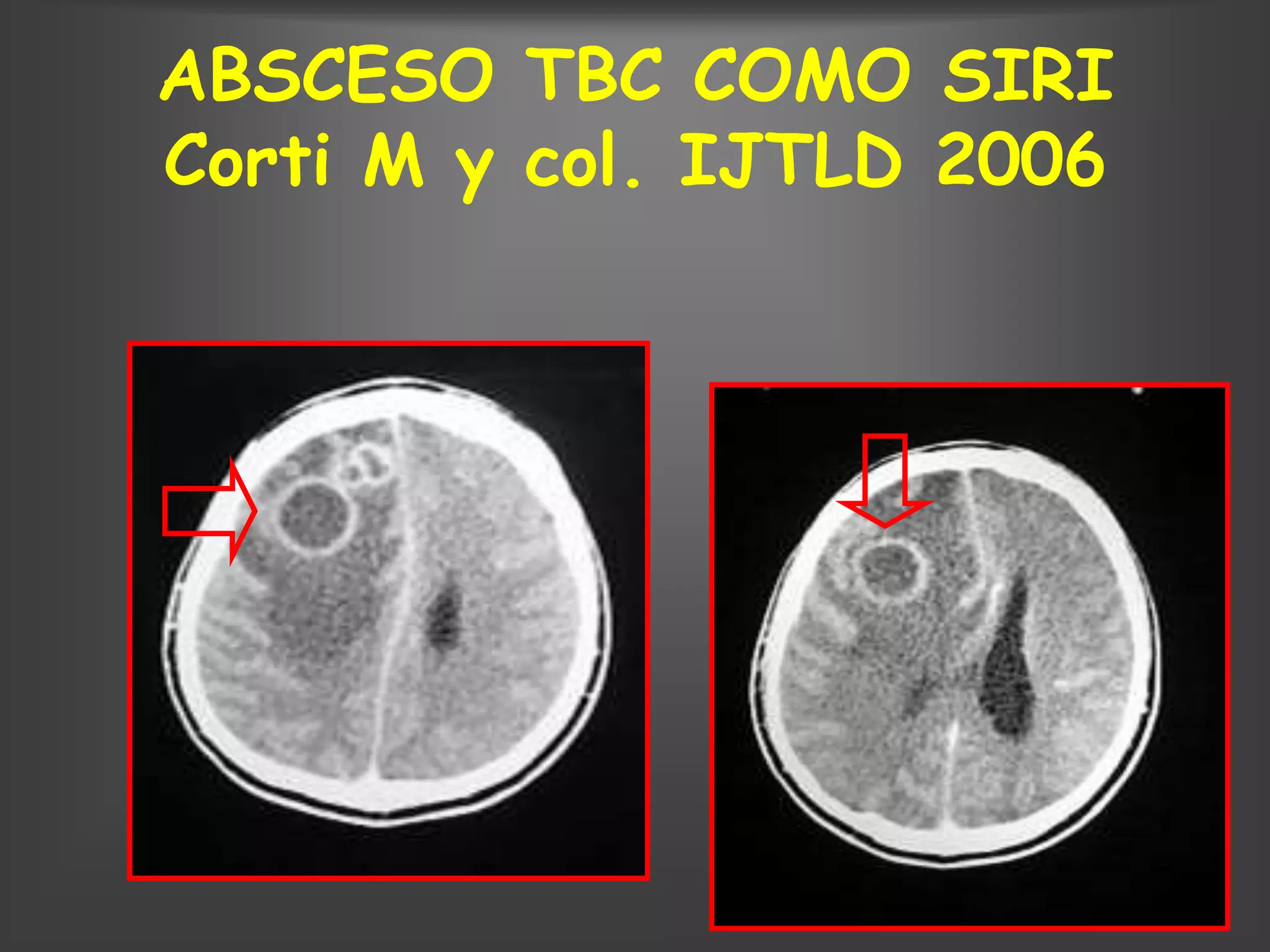 ABSCESO TBC COMO SIRI
Corti M y col. IJTLD 2006
 