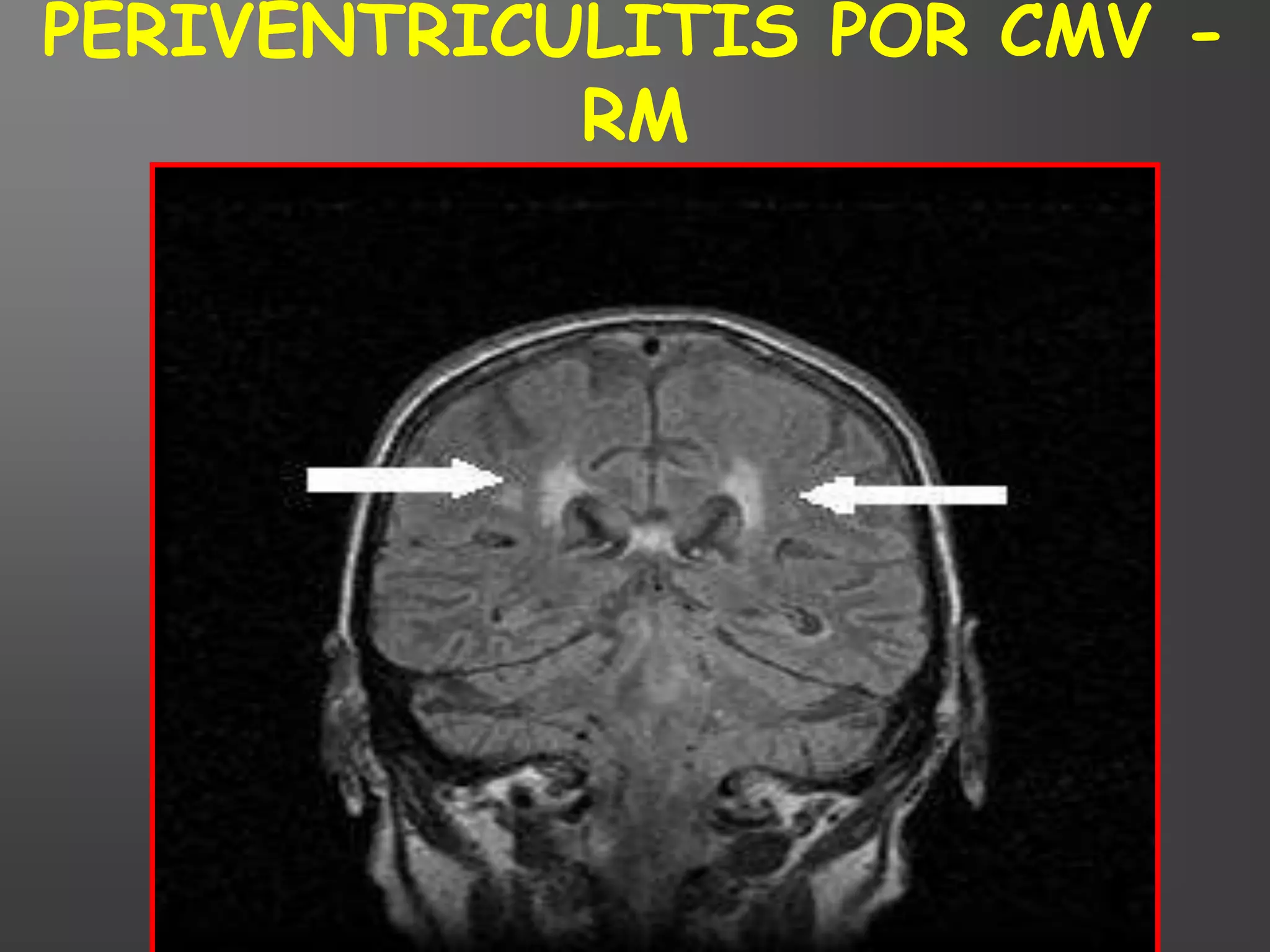 PERIVENTRICULITIS POR CMV -
            RM
 