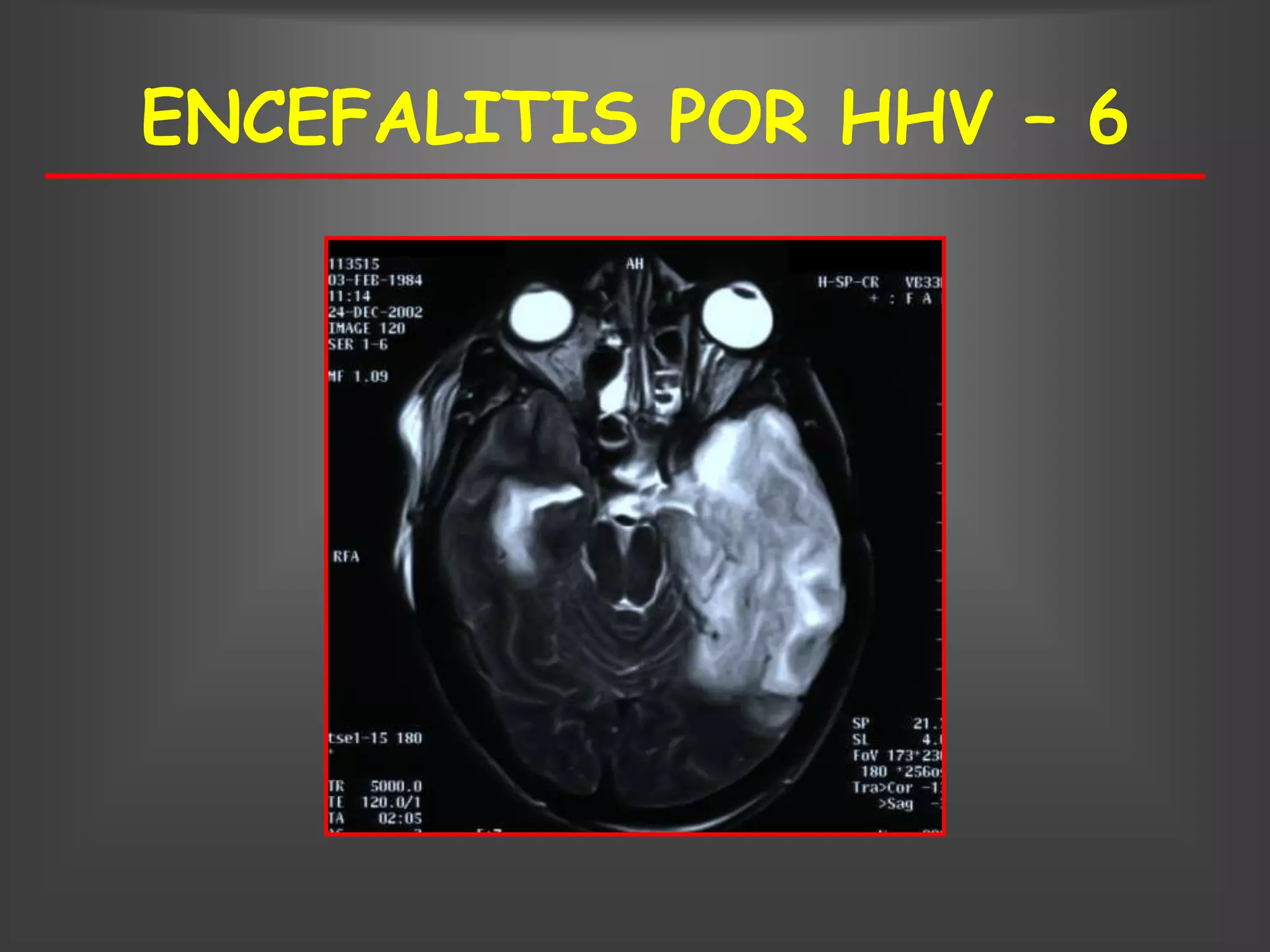 ENCEFALITIS POR HHV – 6
 