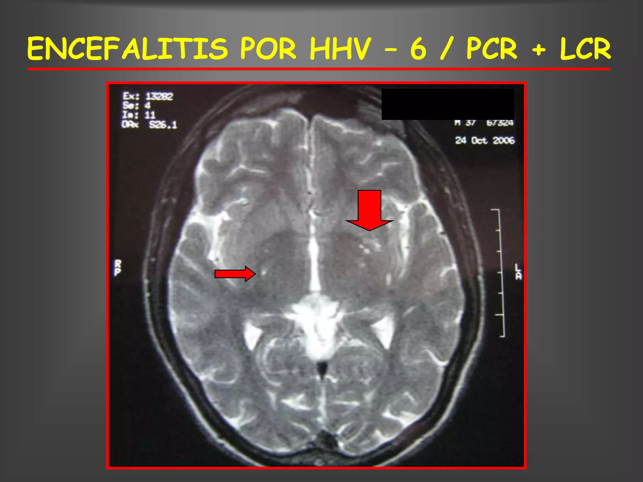ENCEFALITIS POR HHV – 6 / PCR + LCR
 