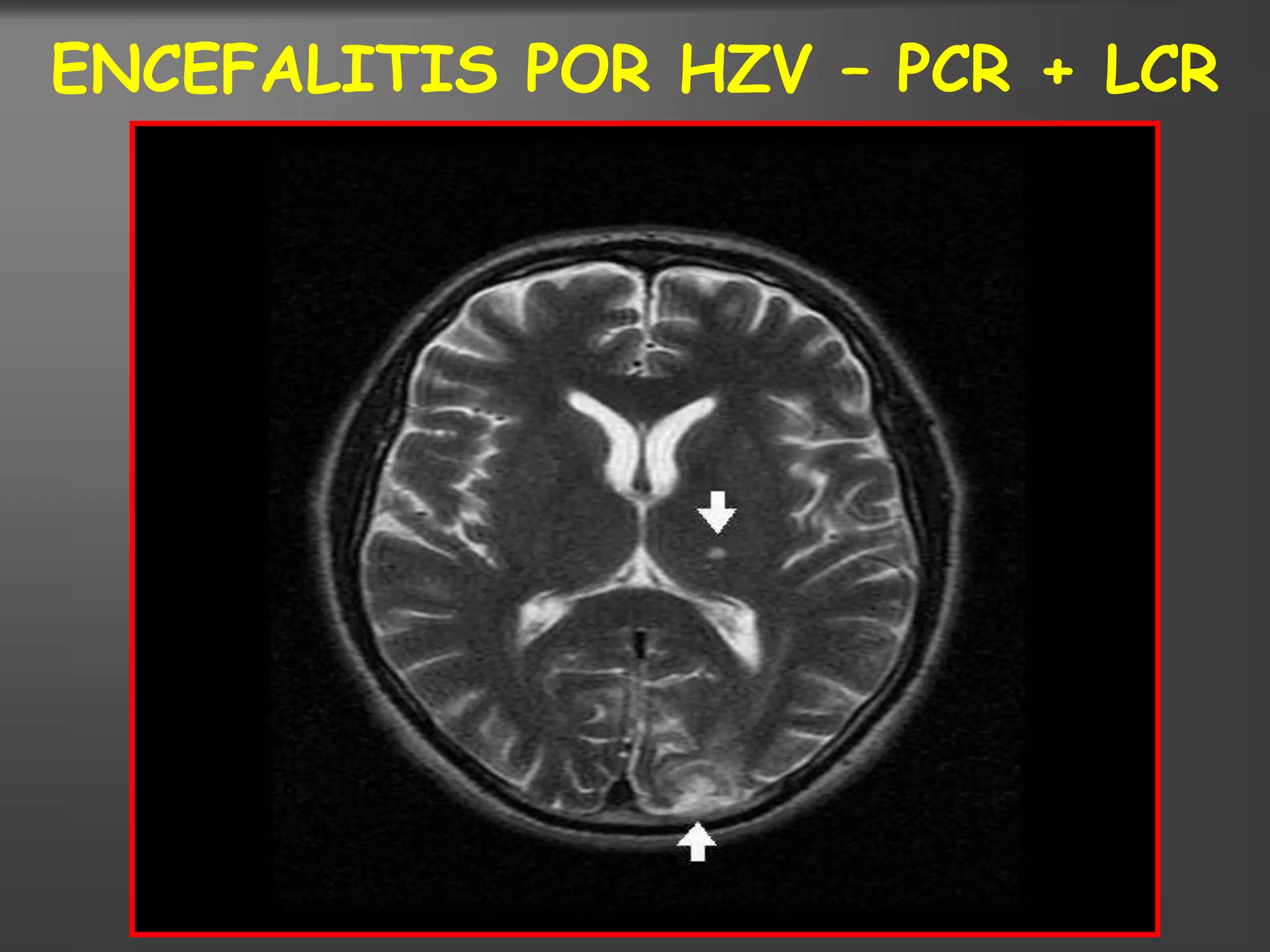 ENCEFALITIS POR HZV – PCR + LCR
 