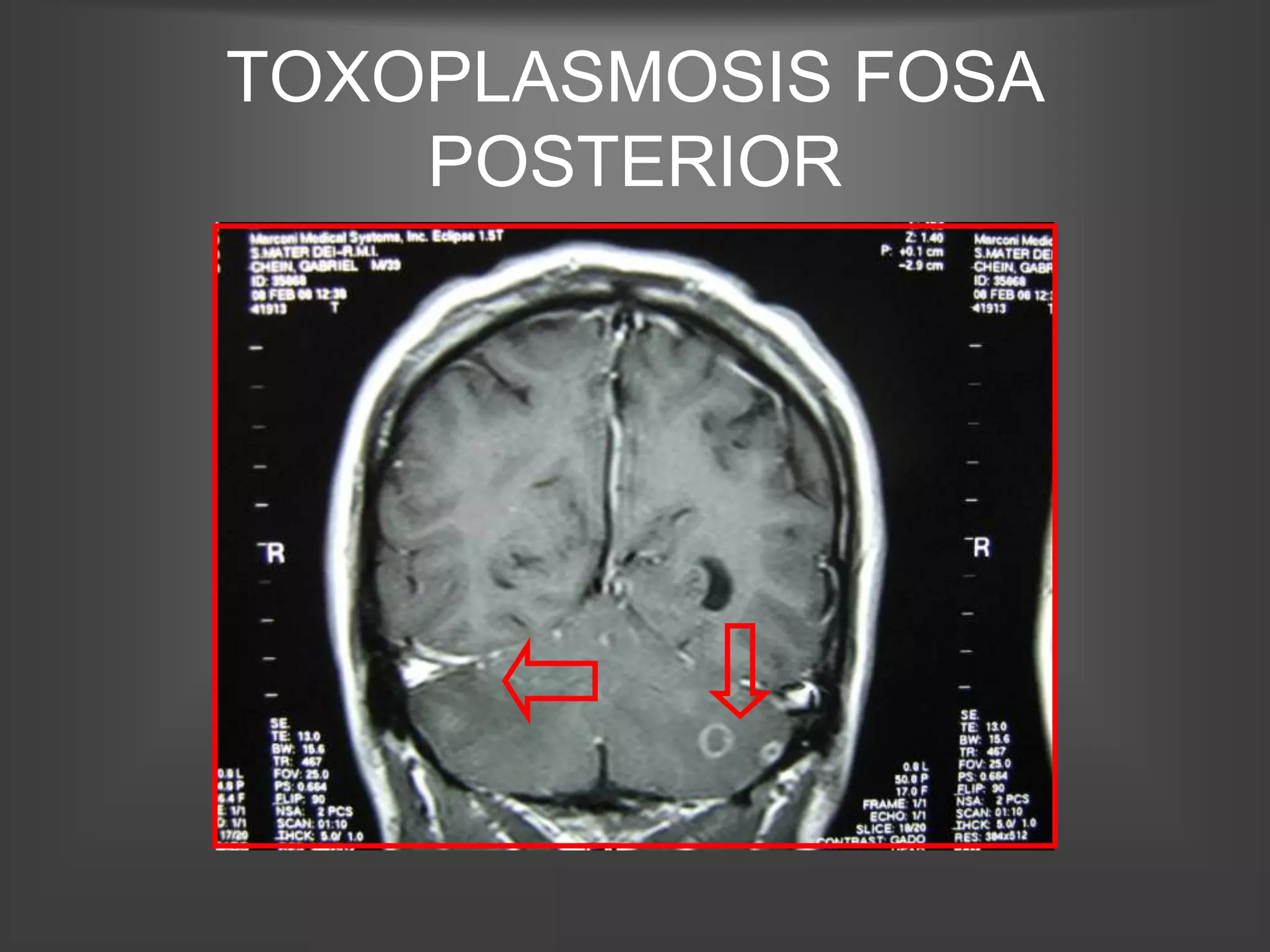 TOXOPLASMOSIS FOSA
    POSTERIOR
 