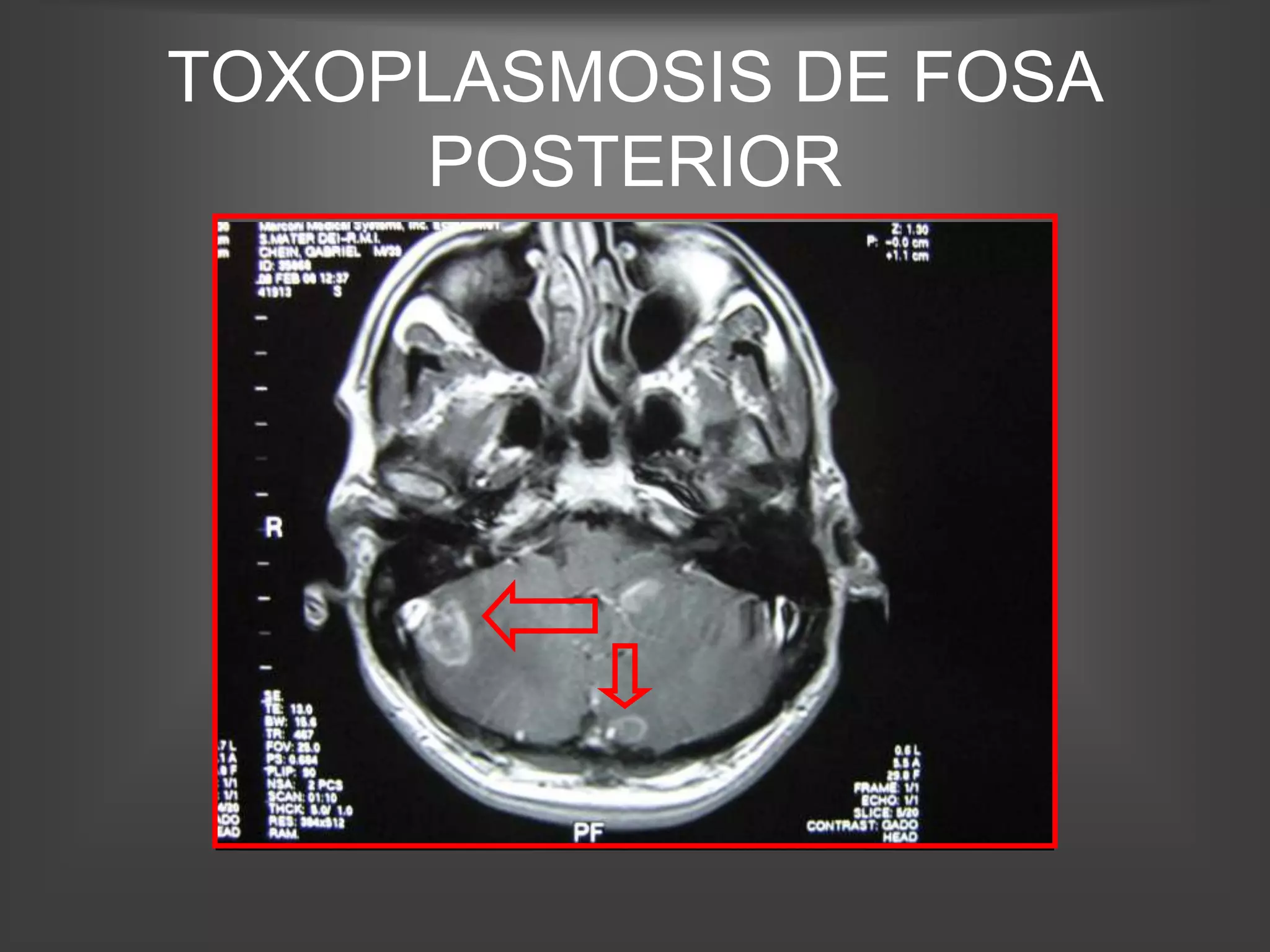 TOXOPLASMOSIS DE FOSA
     POSTERIOR
 