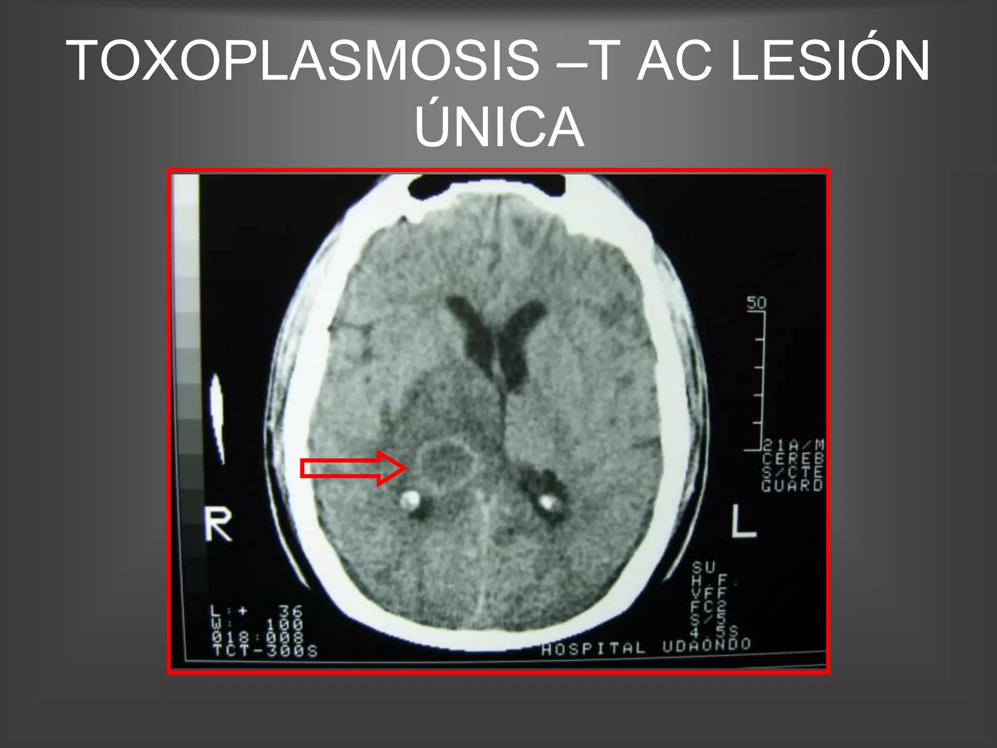 TOXOPLASMOSIS –T AC LESIÓN
         ÚNICA
 