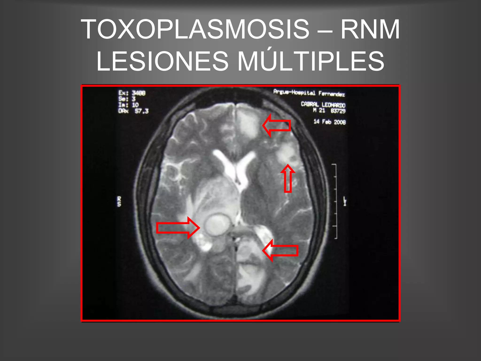 TOXOPLASMOSIS – RNM
 LESIONES MÚLTIPLES
 