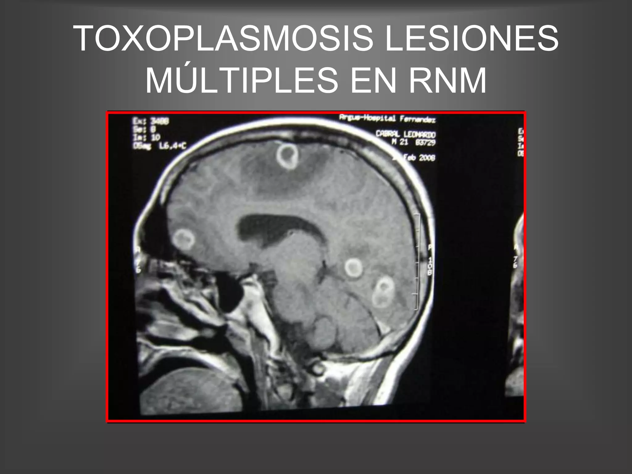 TOXOPLASMOSIS LESIONES
   MÚLTIPLES EN RNM
 