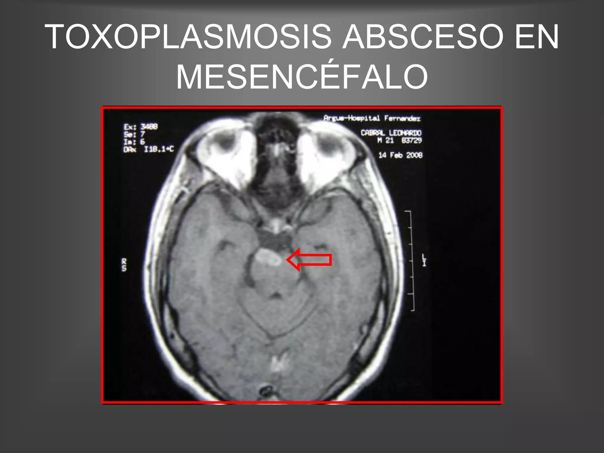 TOXOPLASMOSIS ABSCESO EN
      MESENCÉFALO
 