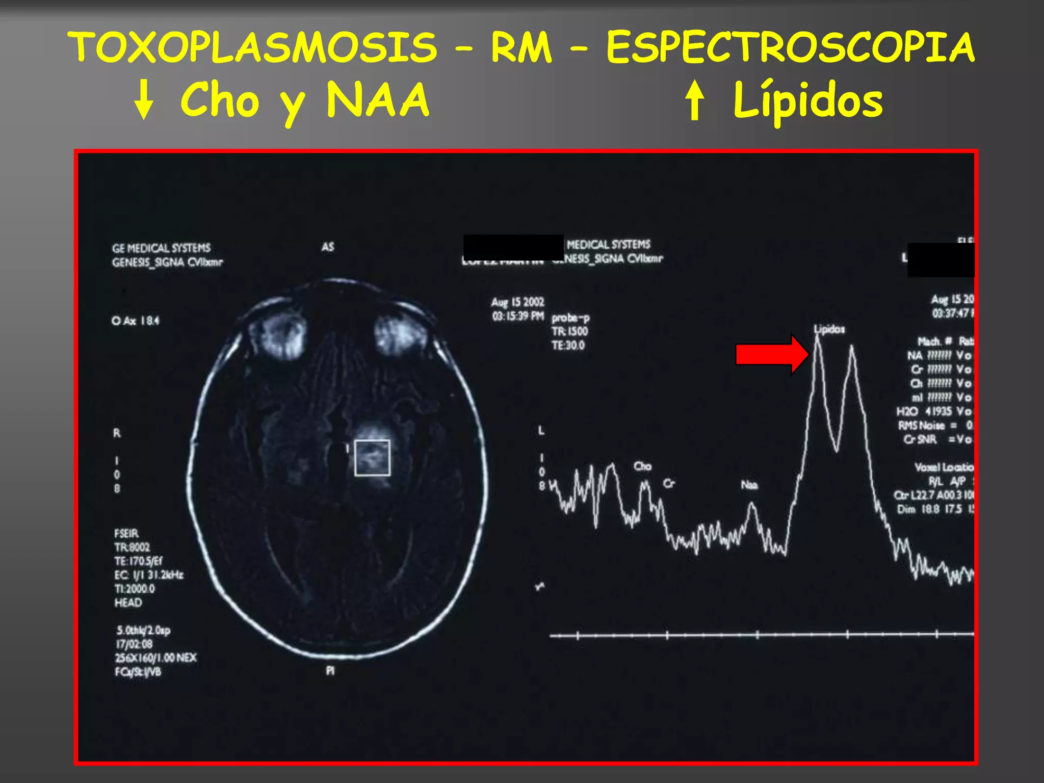 TOXOPLASMOSIS – RM – ESPECTROSCOPIA
    Cho y NAA            Lípidos
 