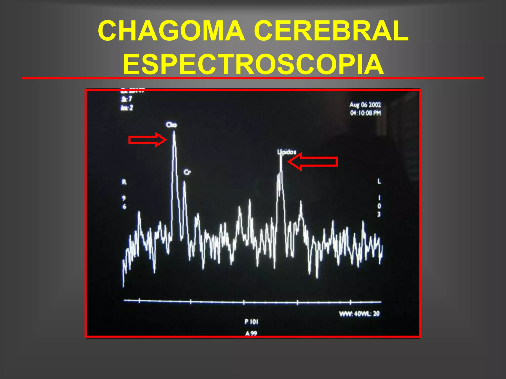 CHAGOMA CEREBRAL
 ESPECTROSCOPIA
 