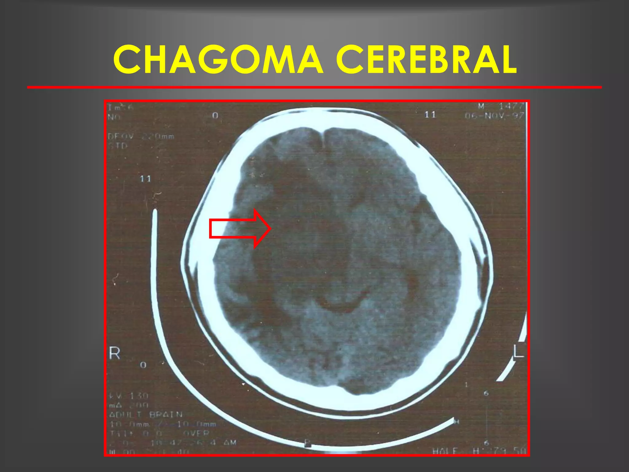 CHAGOMA CEREBRAL
 