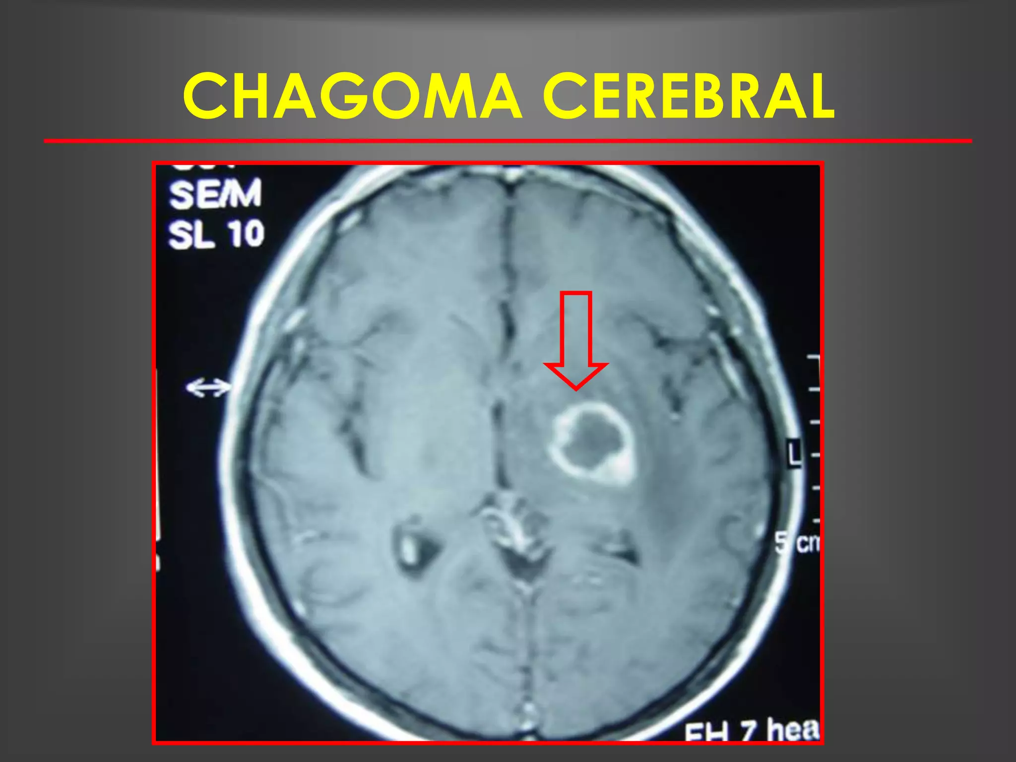 CHAGOMA CEREBRAL
 