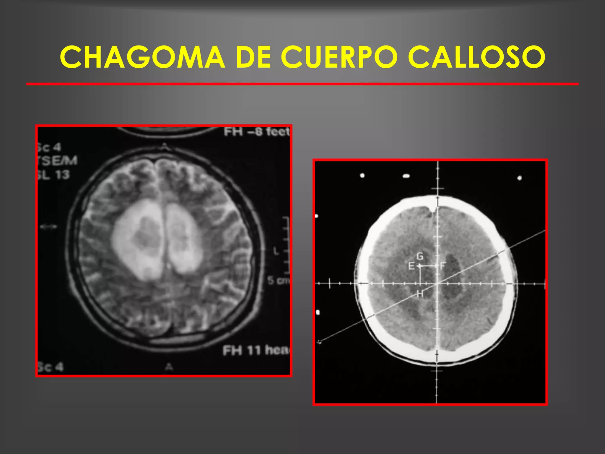 CHAGOMA DE CUERPO CALLOSO
 