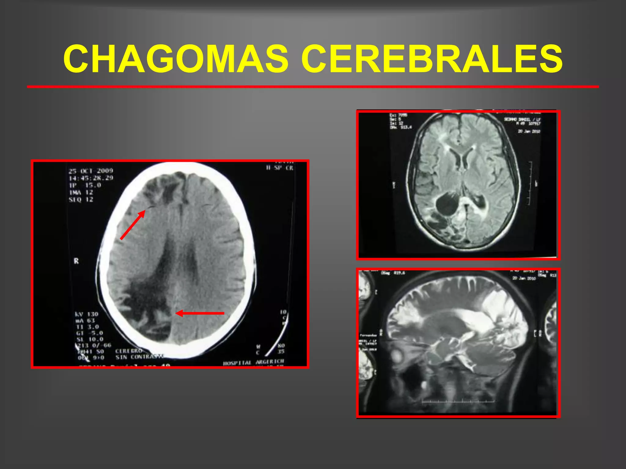 CHAGOMAS CEREBRALES
 