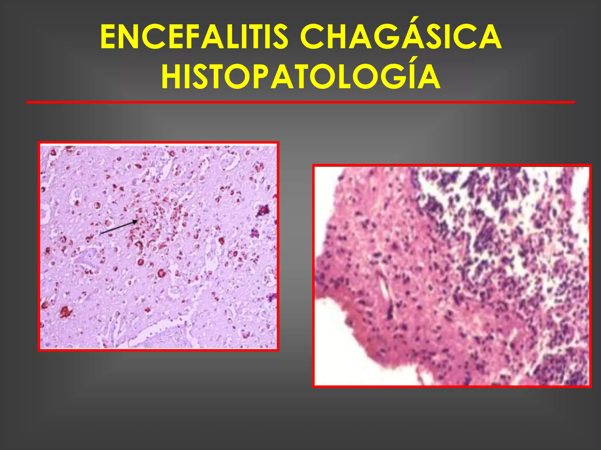 ENCEFALITIS CHAGÁSICA
   HISTOPATOLOGÍA
 