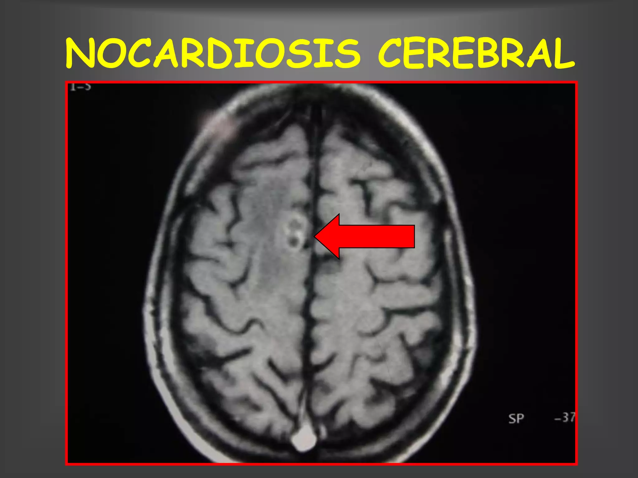 NOCARDIOSIS CEREBRAL
 