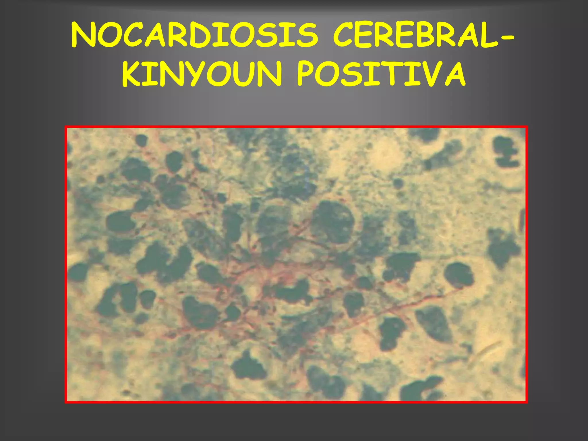 NOCARDIOSIS CEREBRAL-
  KINYOUN POSITIVA
 