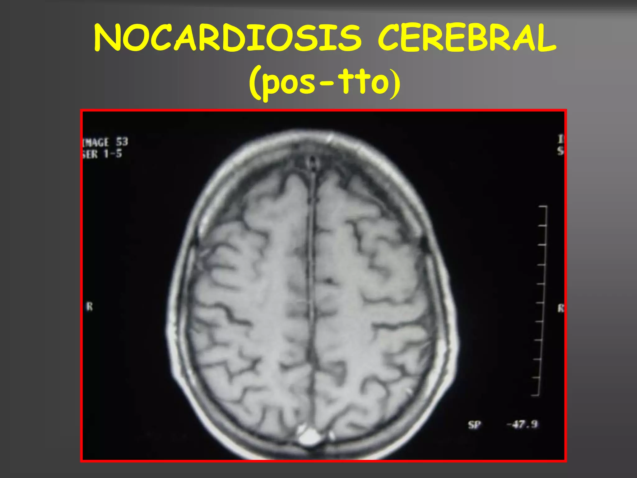 NOCARDIOSIS CEREBRAL
      (pos-tto)
 