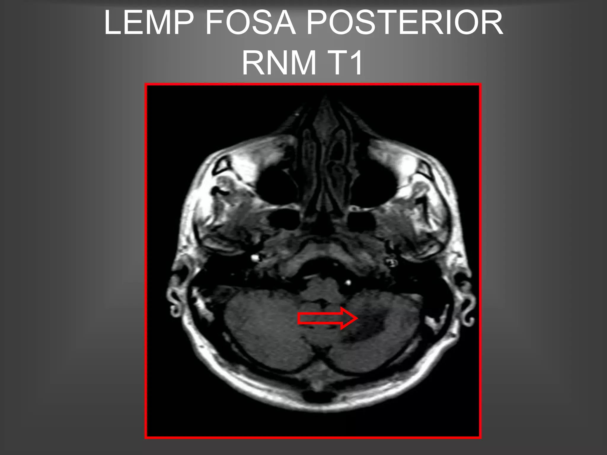 LEMP FOSA POSTERIOR
       RNM T1
 