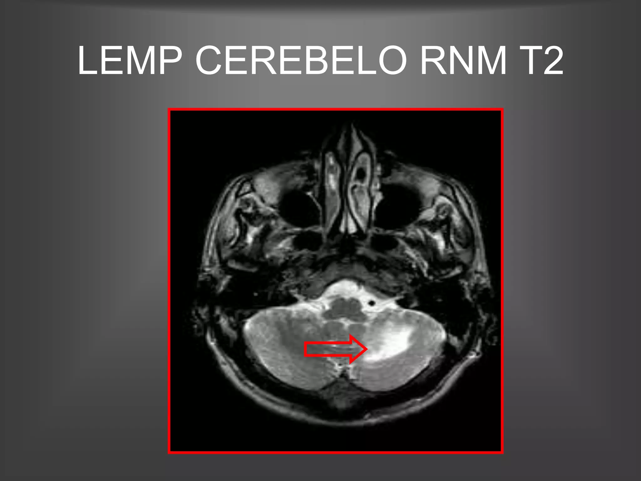 LEMP CEREBELO RNM T2
 